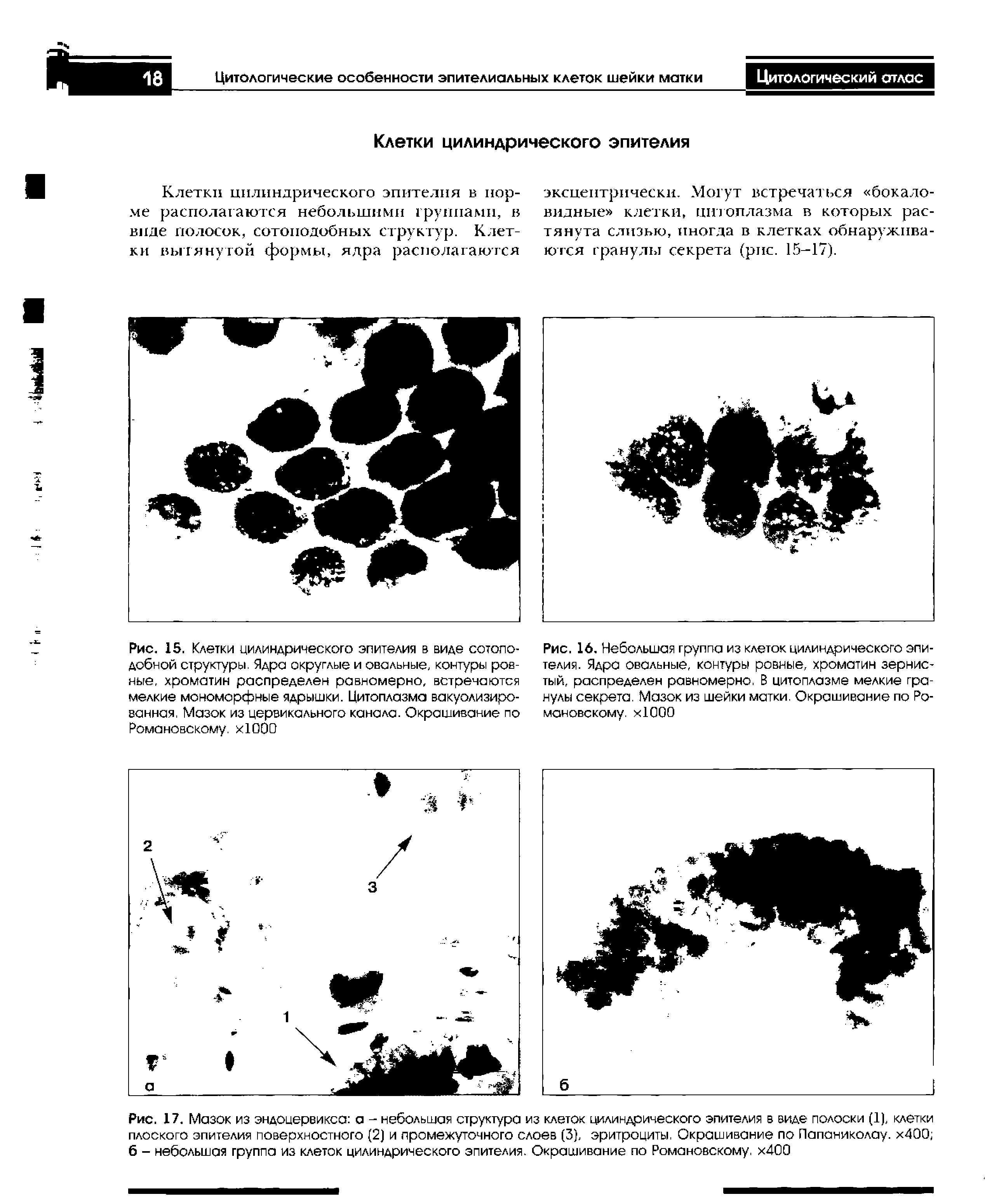 Рис. 17, Мазок из эндоцерв и ко а а - небольшая структура из клеток цилиндрического эпителия в виде полоски (1), клетки плоского эпителия поверхностного (2) и промежуточного слоев (3), эритроциты, Окрашивание по Папаниколау. х400 б - небольшая группа из клеток цилиндрического эпителия. Окрашивание по Романовскому, х400...