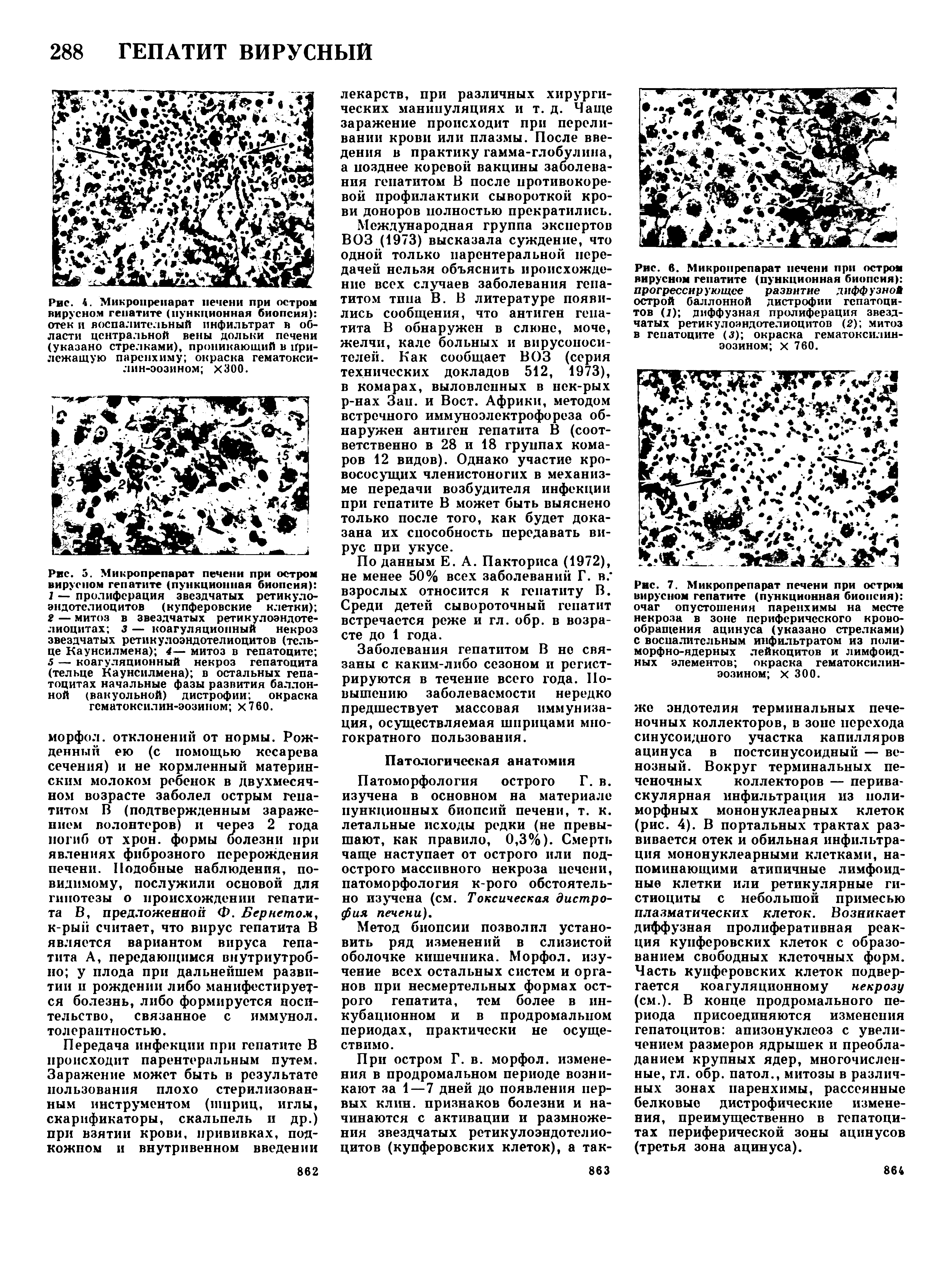 Рис. 5. Микропрепарат печени при остром вирусном гепатите (пункционная биопсия) ...