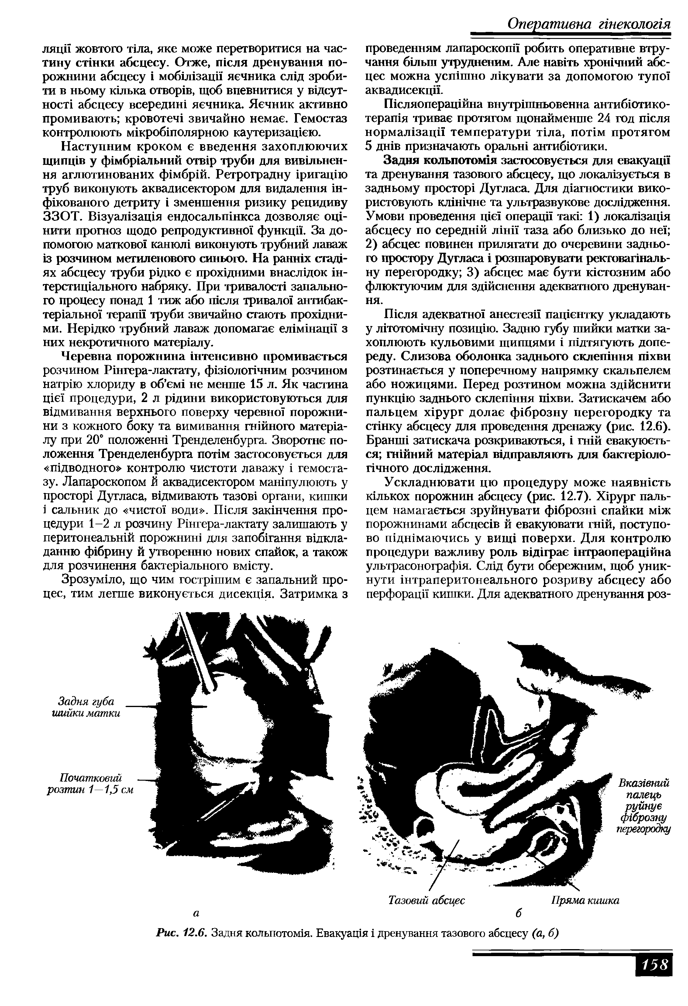 Рис. 12.6. Задня кольпотом1я. Евакуашя дренування тазового абсцесу (а, б)...