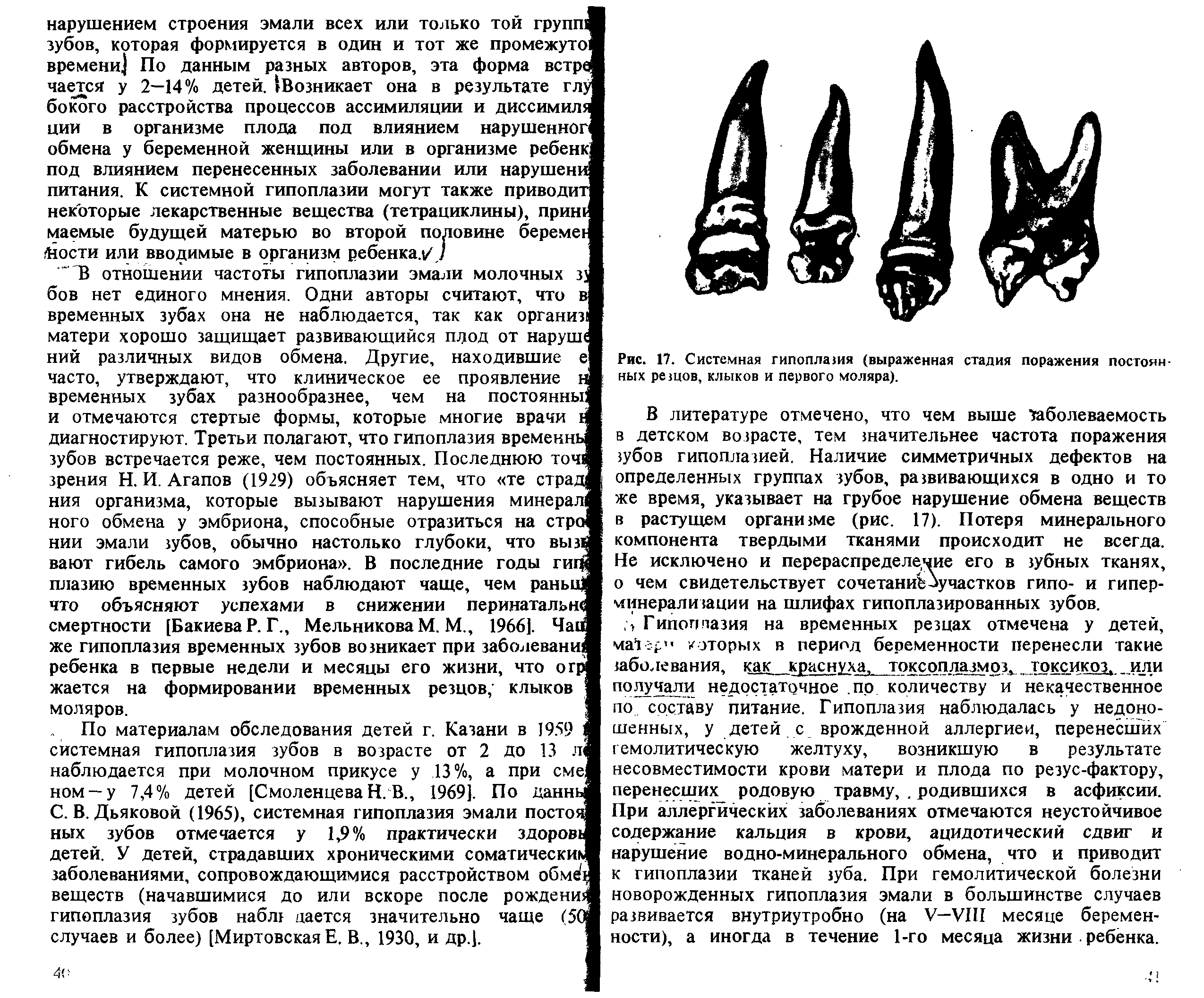 Рис. 17. Системная гипоплазия (выраженная стадия поражения постоян ных резцов, клыков и первого моляра).