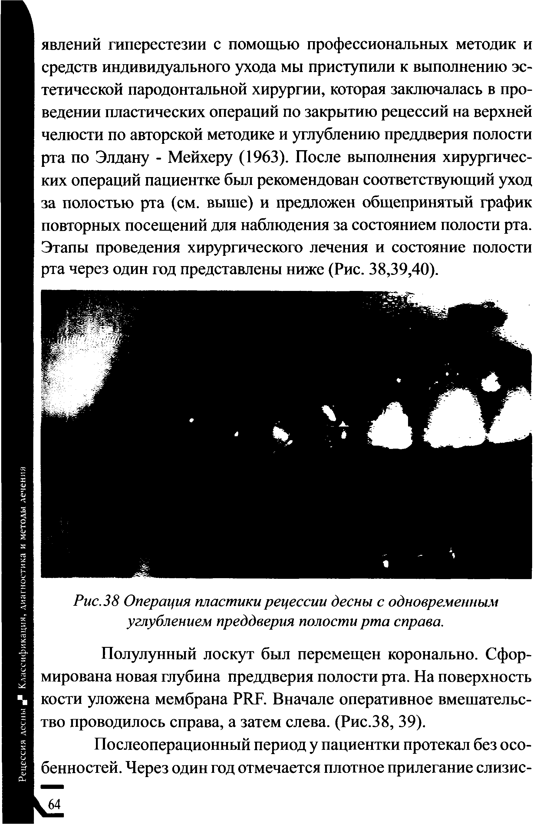 Рис. 38 Операция пластики рецессии десны с одновременным углублением преддверия полости рта справа.