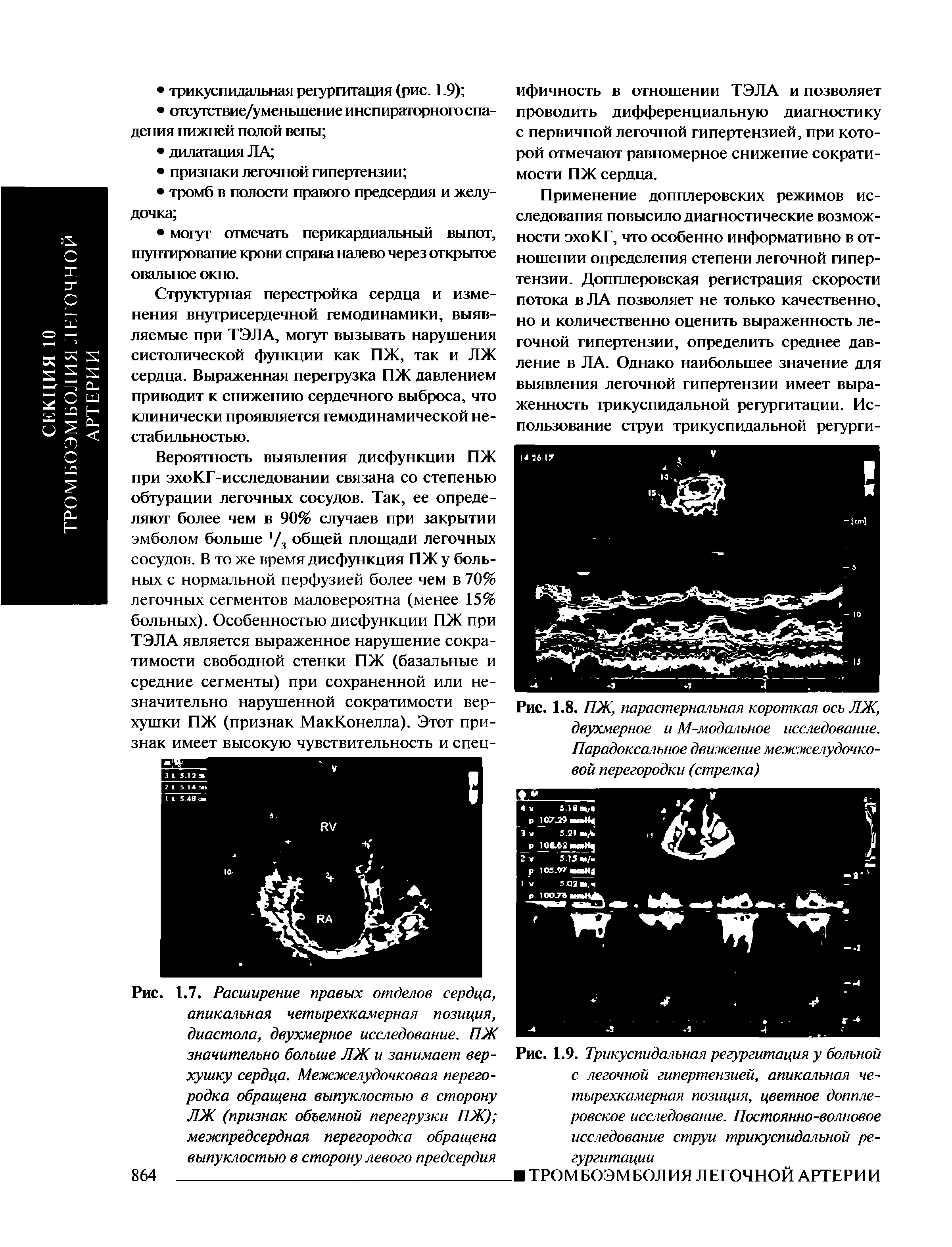 Рис. 1.9. Трикуспидальная регургитация у больной с легочной гипертензией, апикальная четырехкамерная позиция, цветное допплеровское исследование. Постоянно-волновое исследование струи трикуспидальной регургитации...