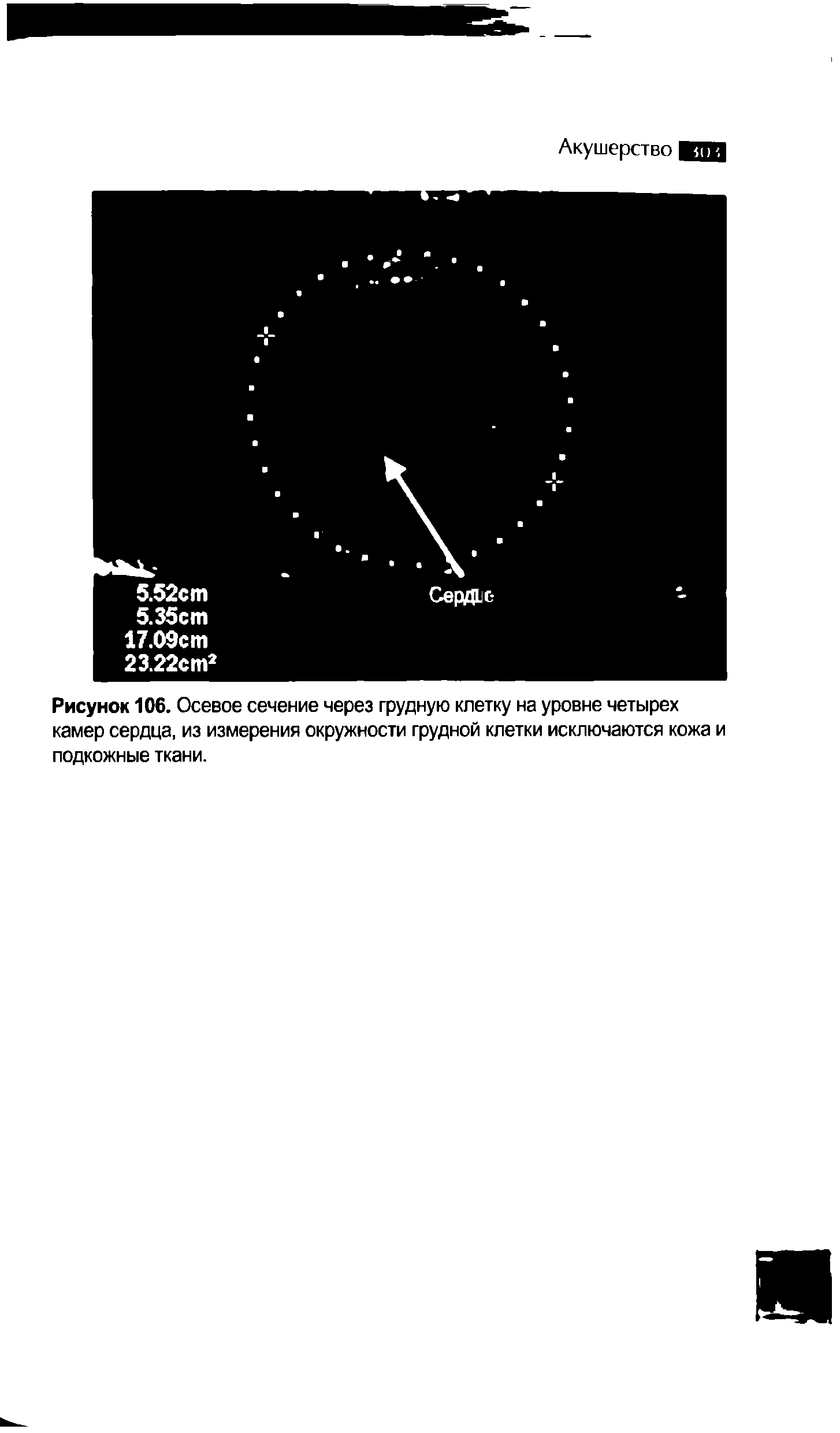 Рисунок 106. Осевое сечение через грудную клетку на уровне четырех камер сердца, из измерения окружности грудной клетки исключаются кожа и подкожные ткани.