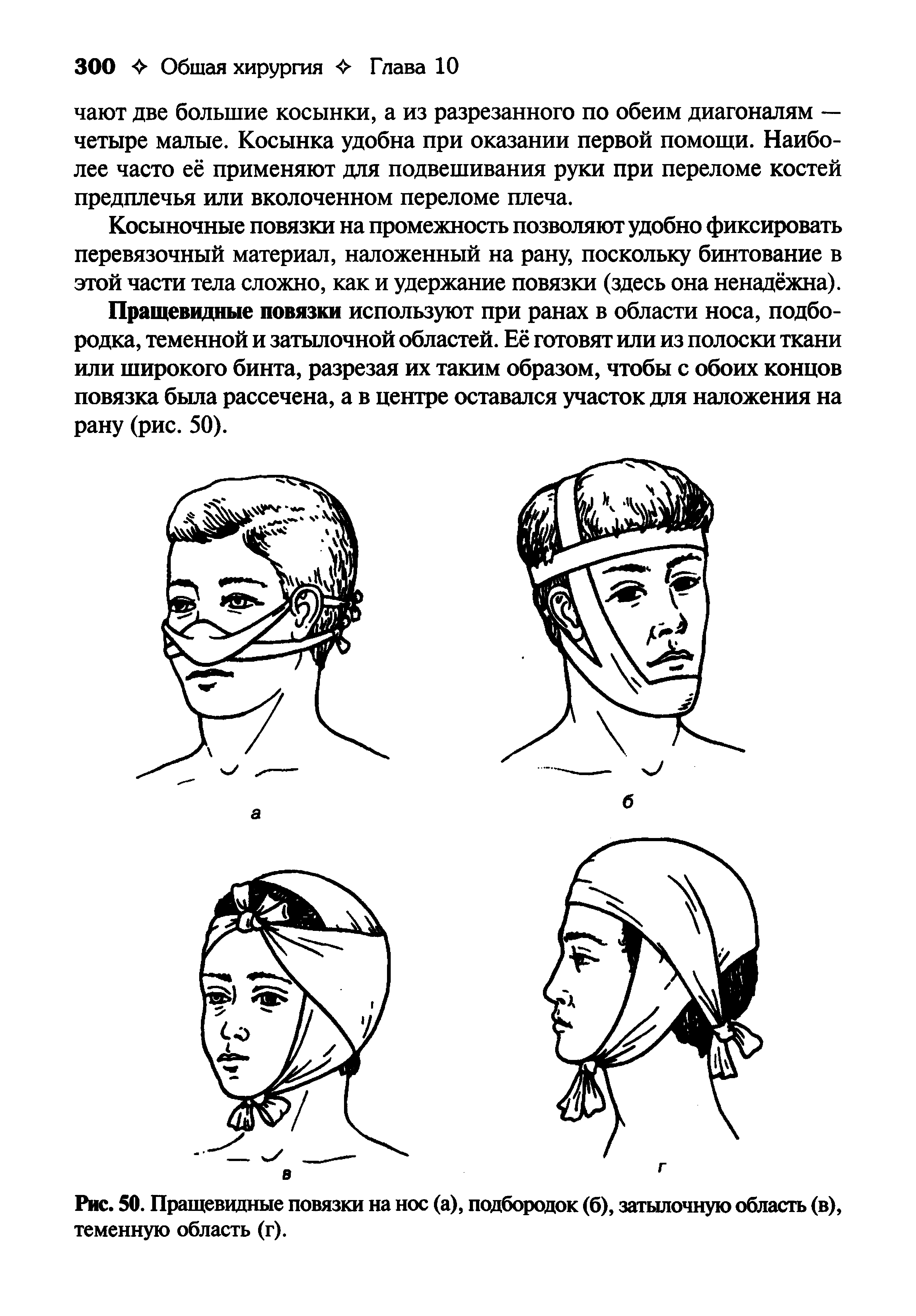 Рис. 50. Пращевидные повязки на нос (а), подбородок (б), затылочную область (в), теменную область (г).