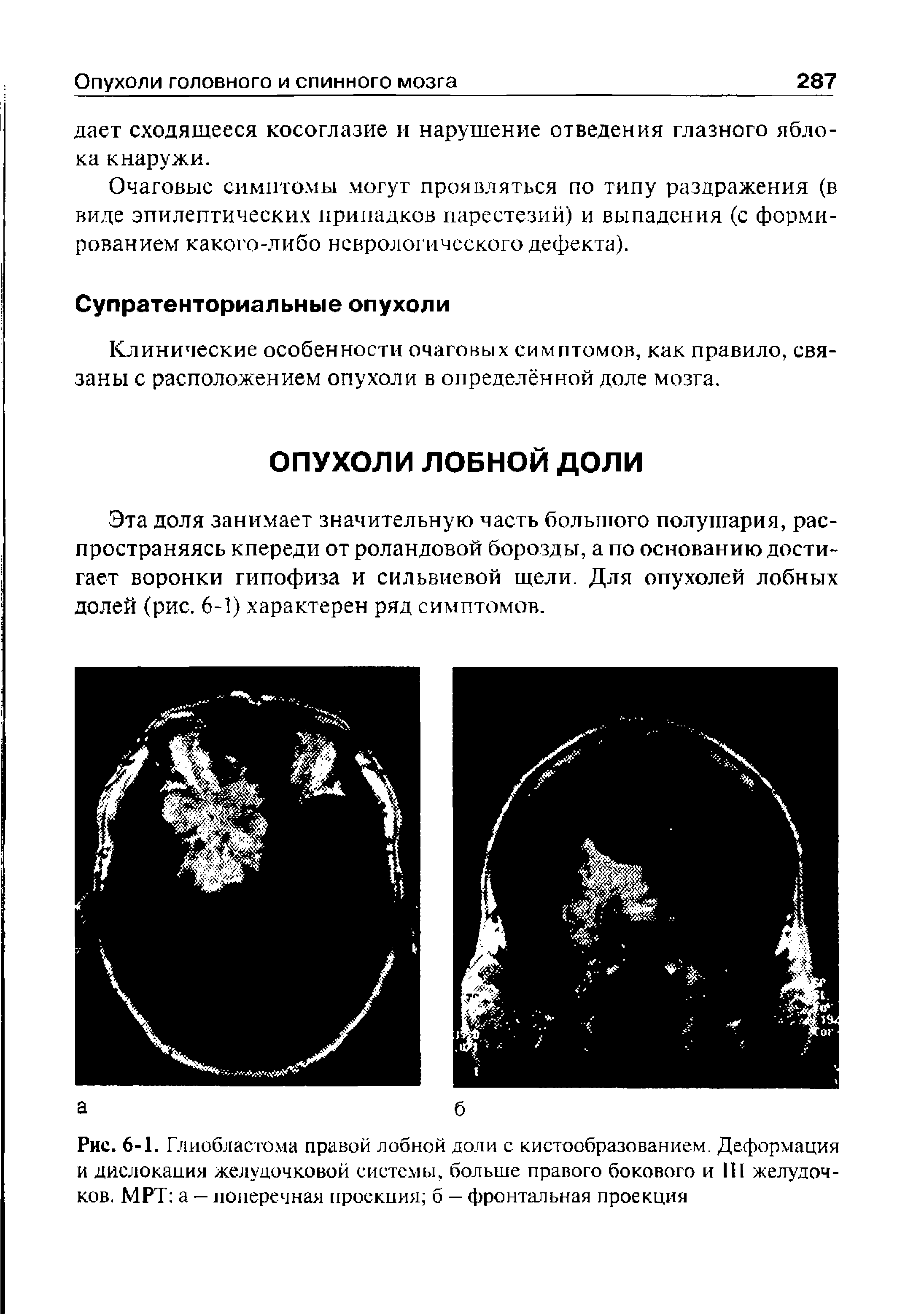 Рис. 6-1. Глиобластома правой лобной доли с кистообразованием. Деформация и дислокация желудочковой системы, больше правого бокового и III желудочков. МРТ а — поперечная проекция б — фронтальная проекция...