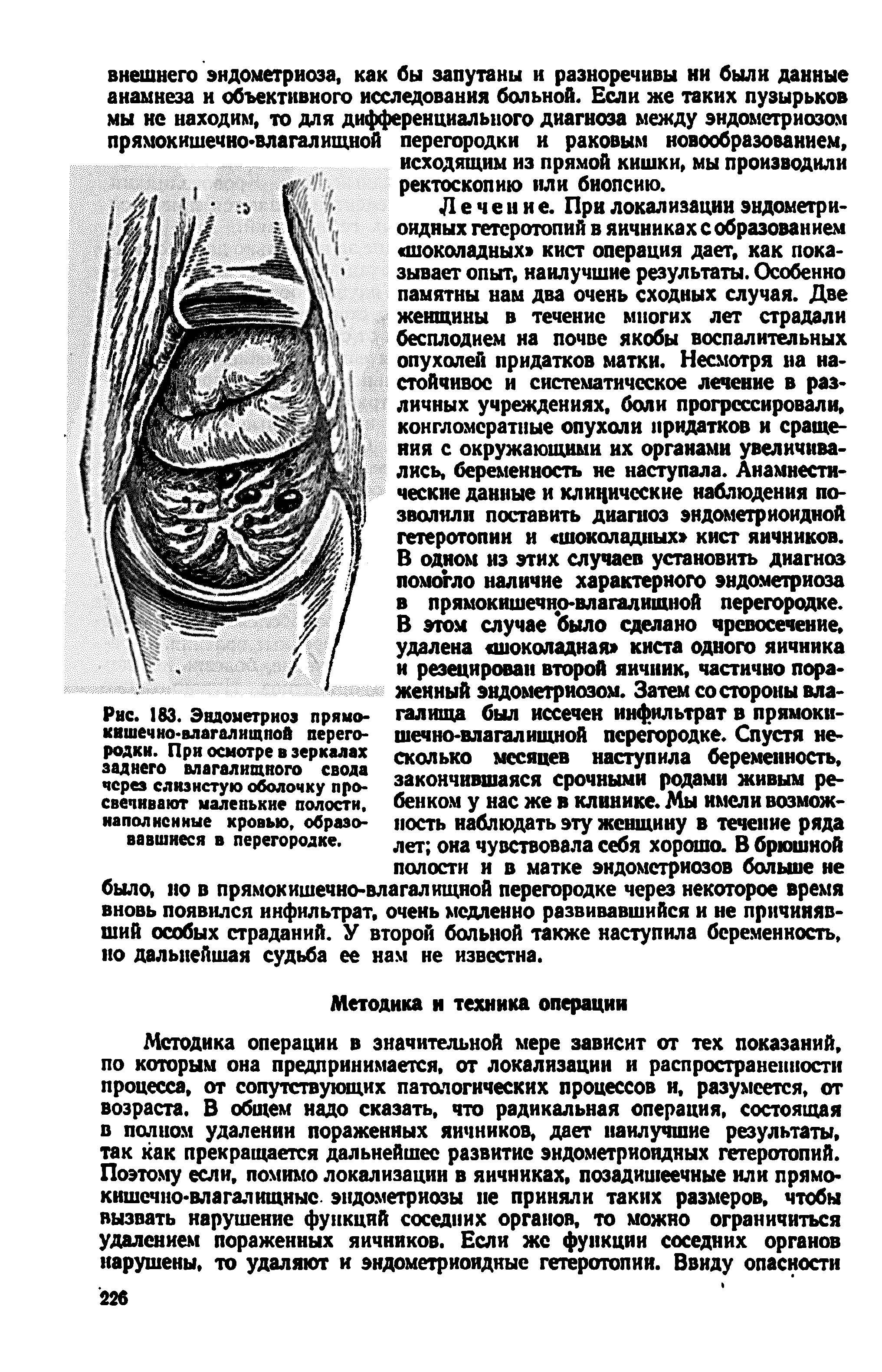 Рис. 183. Эвдометриоэ прямокишечно-влагалищной перегородки. При осмотре в зеркалах заднего влагалищного свода через слизистую оболочку просвечивают маленькие полости, наполненные кровью, образовавшиеся в перегородке.