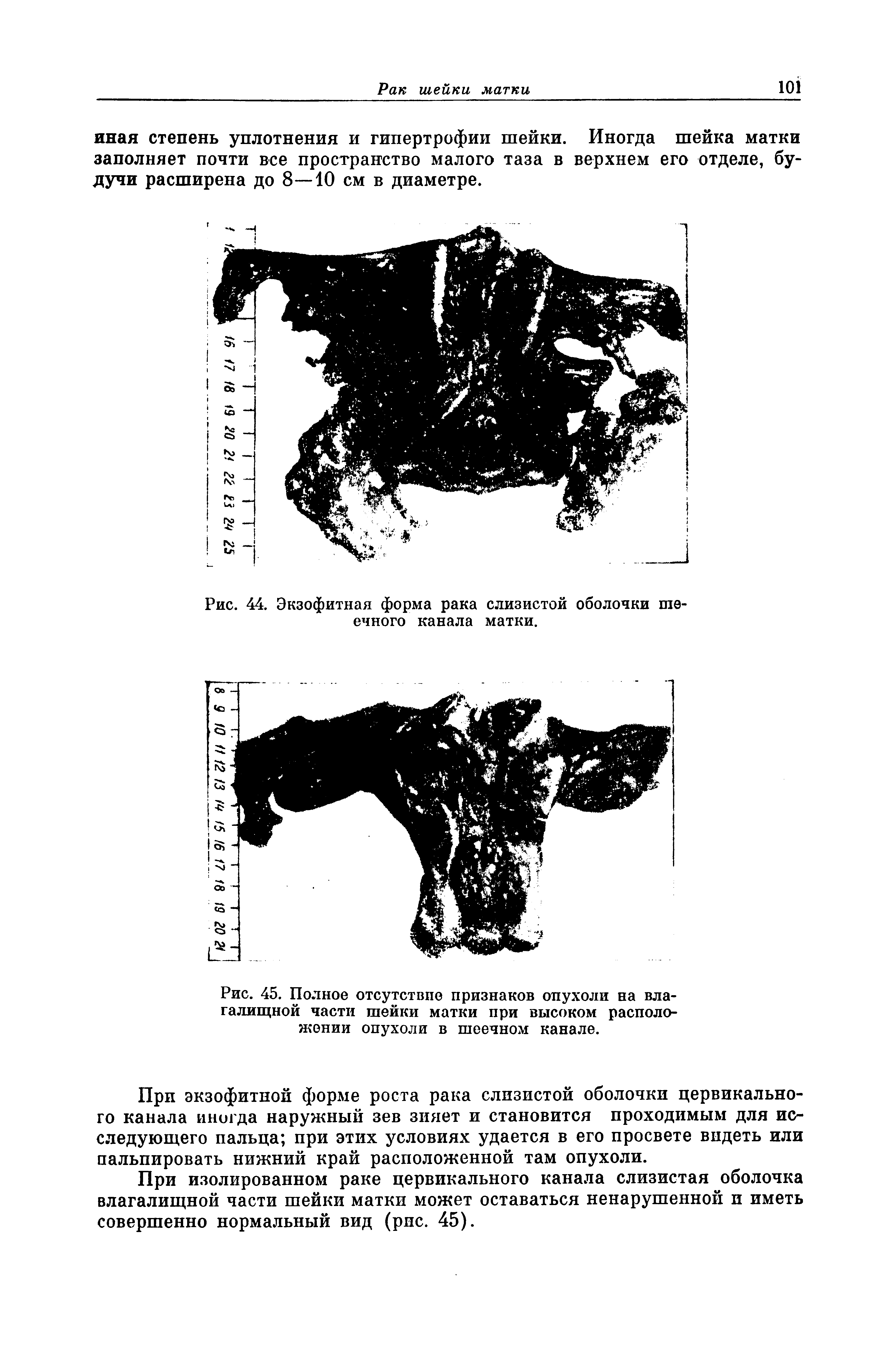 Рис. 44. Экзофитная форма рака слизистой оболочки шеечного канала матки.