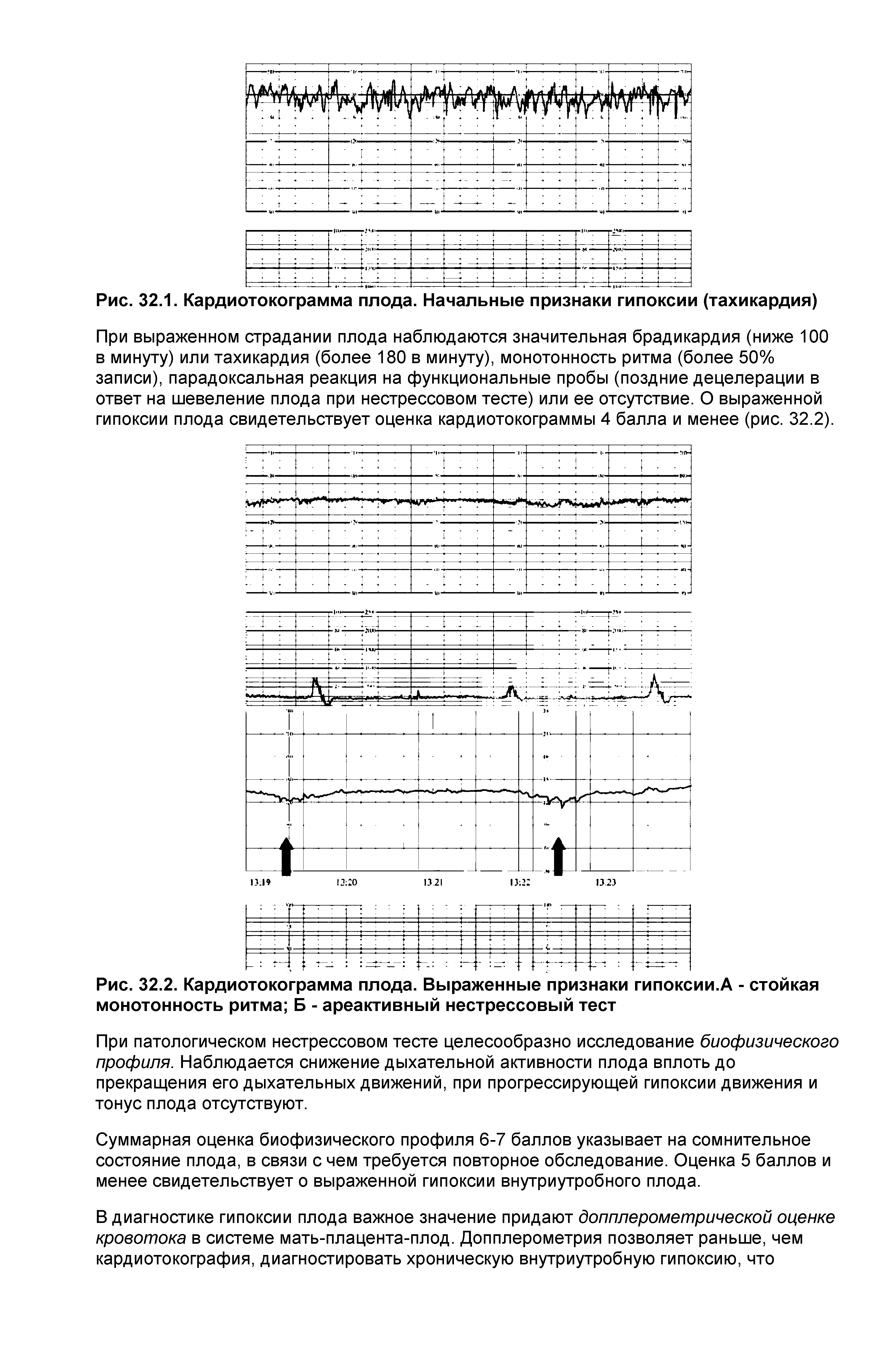 Рис. 32.1. Карди ото ко грамма плода. Начальные признаки гипоксии (тахикардия)...