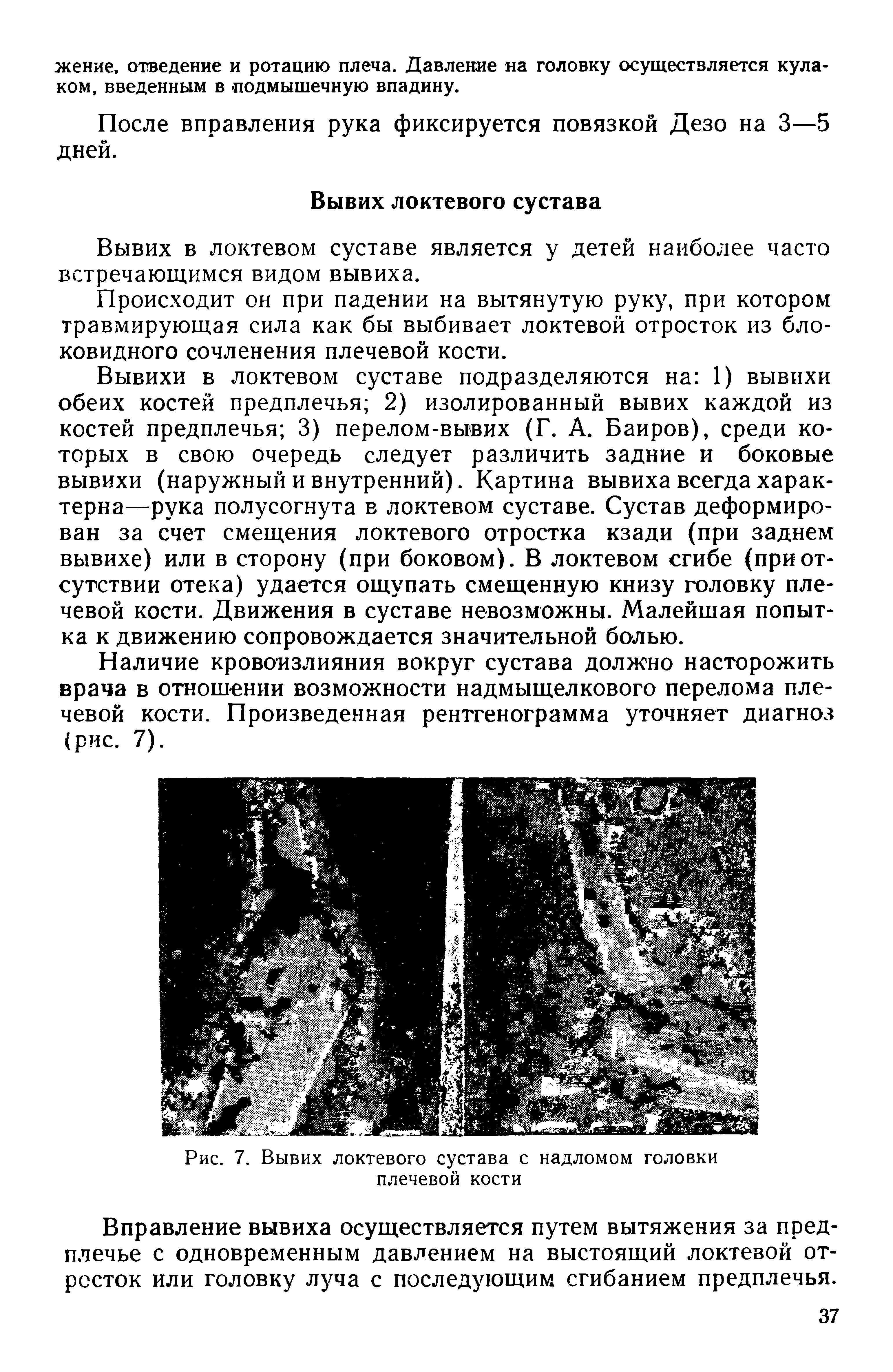 Рис. 7. Вывих локтевого сустава с надломом головки плечевой кости...