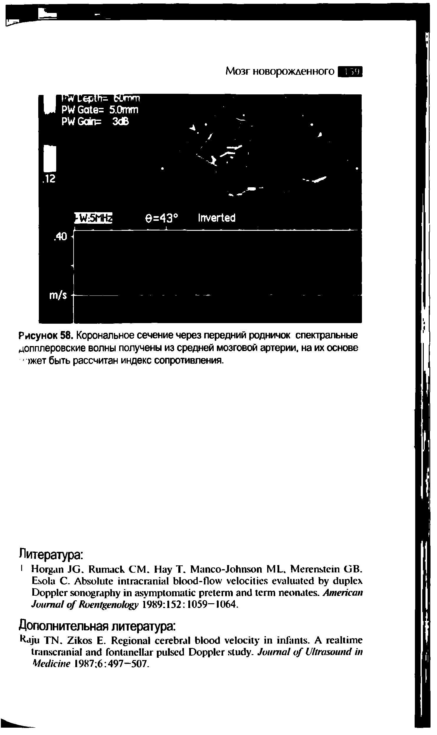 Рисунок 58. Корональное сечение через передний родничок спектральные допплеровские волны получены из средней мозговой артерии, на их основе >жет быть рассчитан индекс сопротивления.