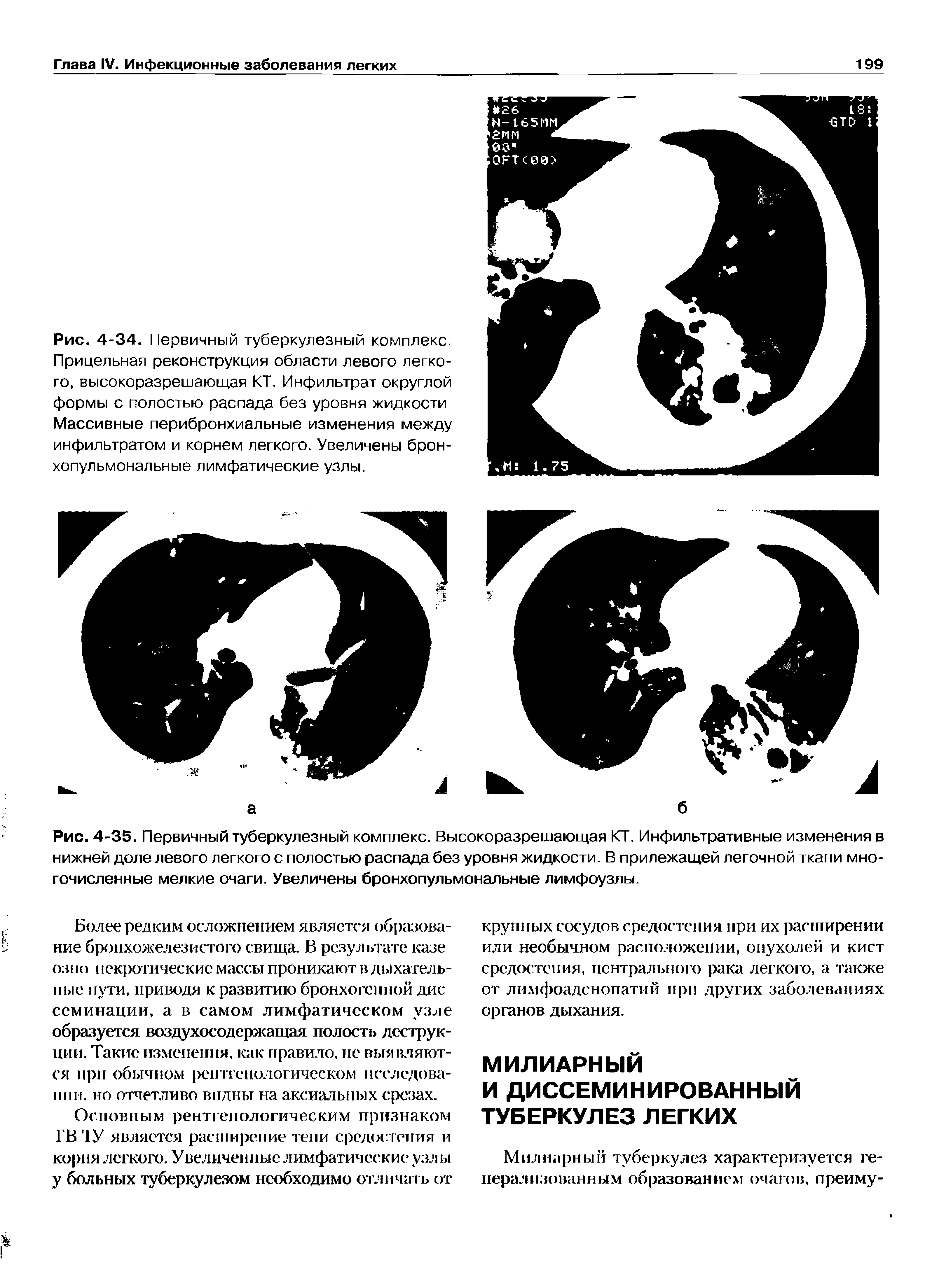 Рис. 4-35. Первичный туберкулезный комплекс. Высокоразрешающая КТ. Инфильтративные изменения в нижней доле левого легкого с полостью распада без уровня жидкости. В прилежащей легочной ткани многочисленные мелкие очаги. Увеличены бронхопульмональные лимфоузлы.