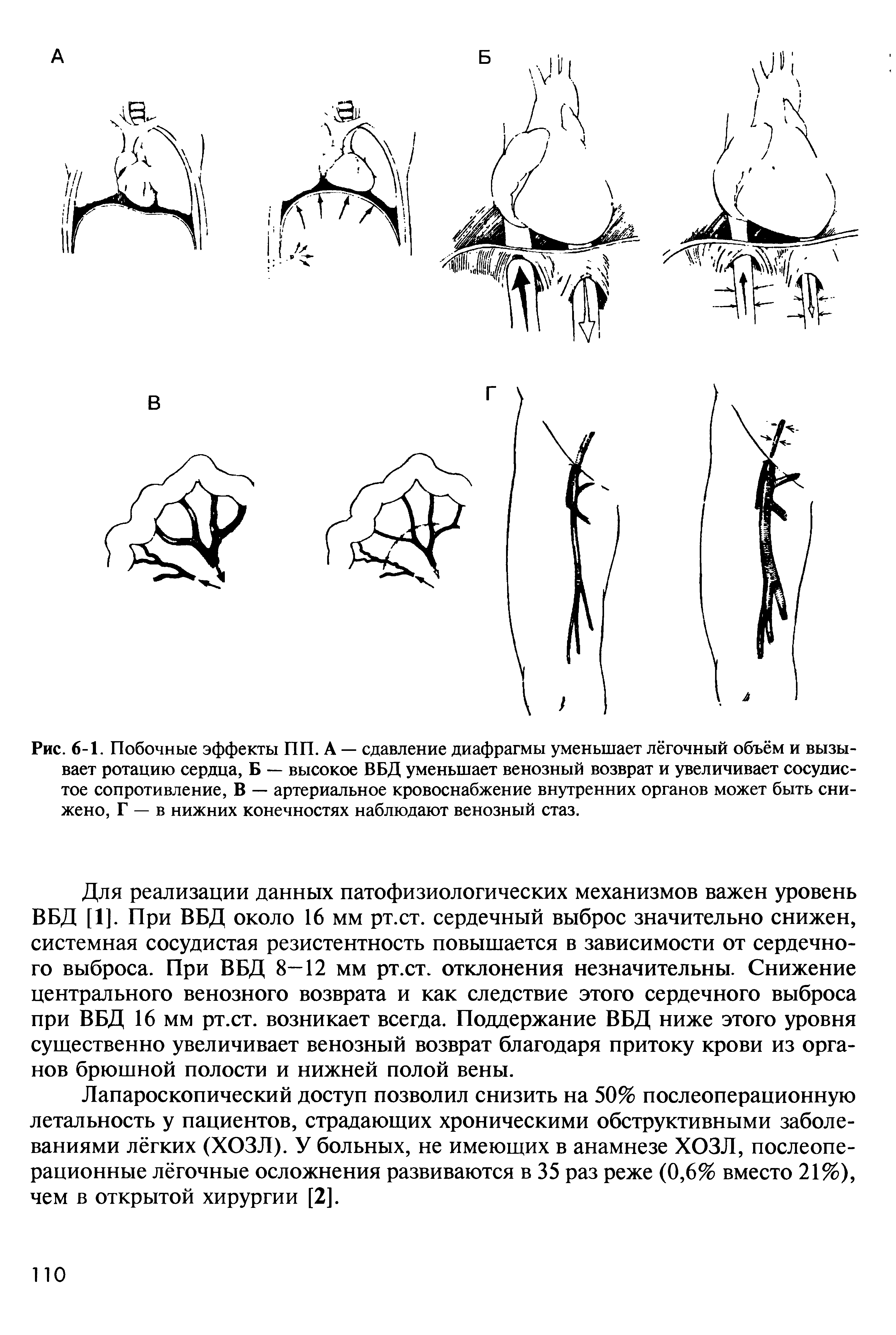 Рис. 6-1. Побочные эффекты ПП. А — сдавление диафрагмы уменьшает лёгочный объём и вызывает ротацию сердца, Б — высокое ВБД уменьшает венозный возврат и увеличивает сосудистое сопротивление, В — артериальное кровоснабжение внутренних органов может быть снижено, Г — в нижних конечностях наблюдают венозный стаз.