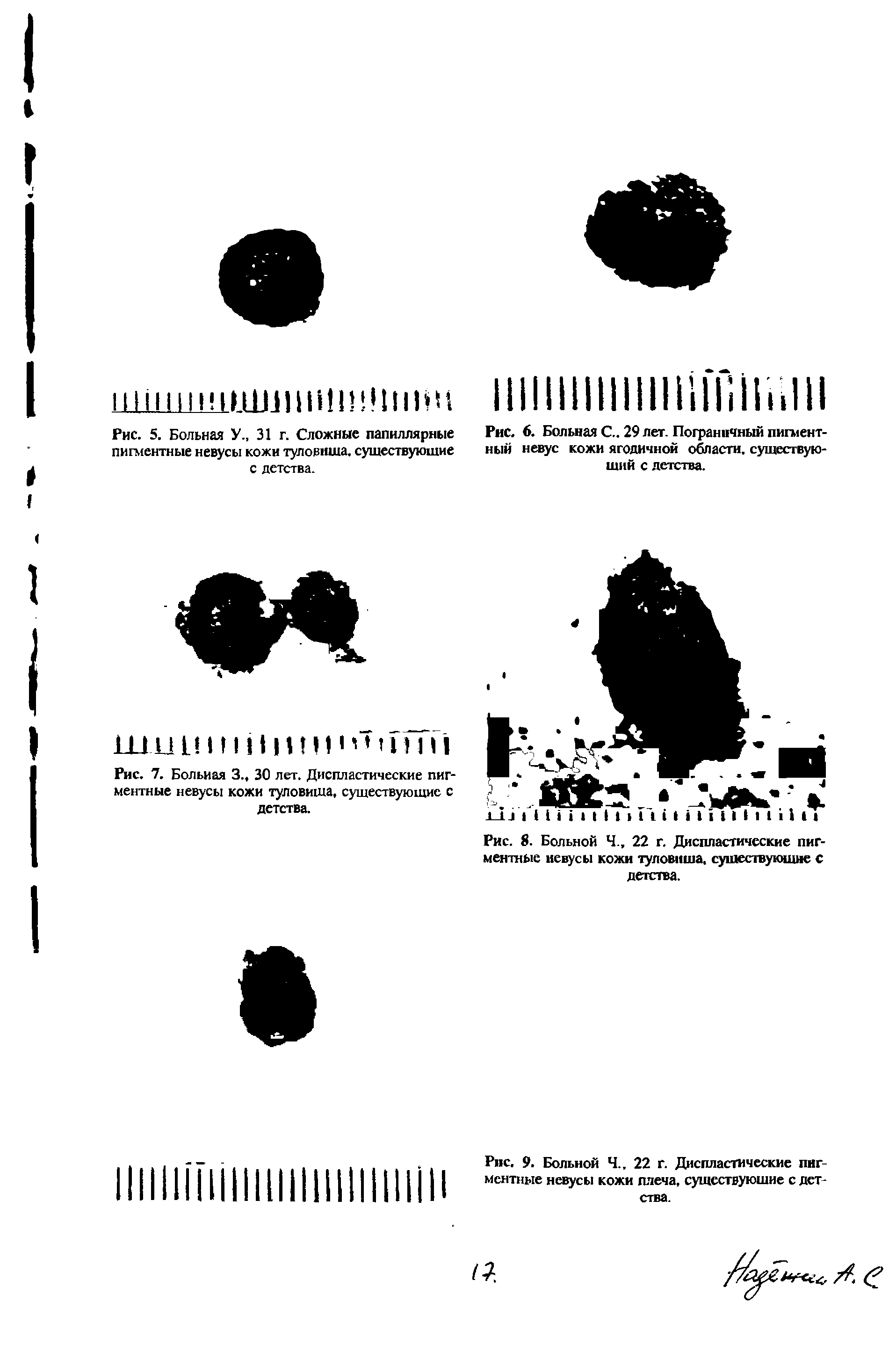 Рис. 8. Больной Ч., 22 г. Диспластические пигментные невусы кожи туловища, существующие С детства.