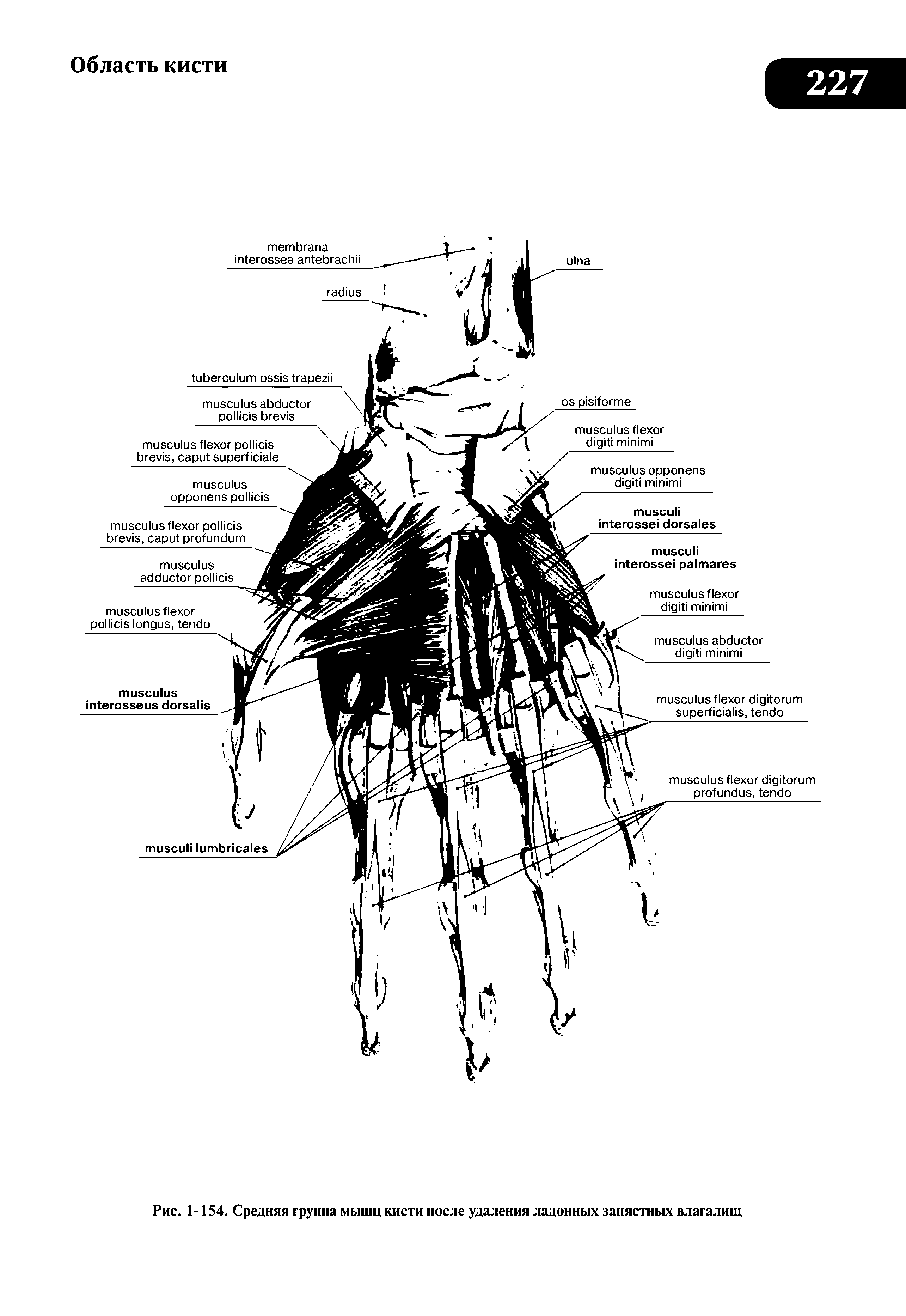 Рис. 1-154. Средняя группа мышц кисти после удаления ладонных запястных влагалищ...