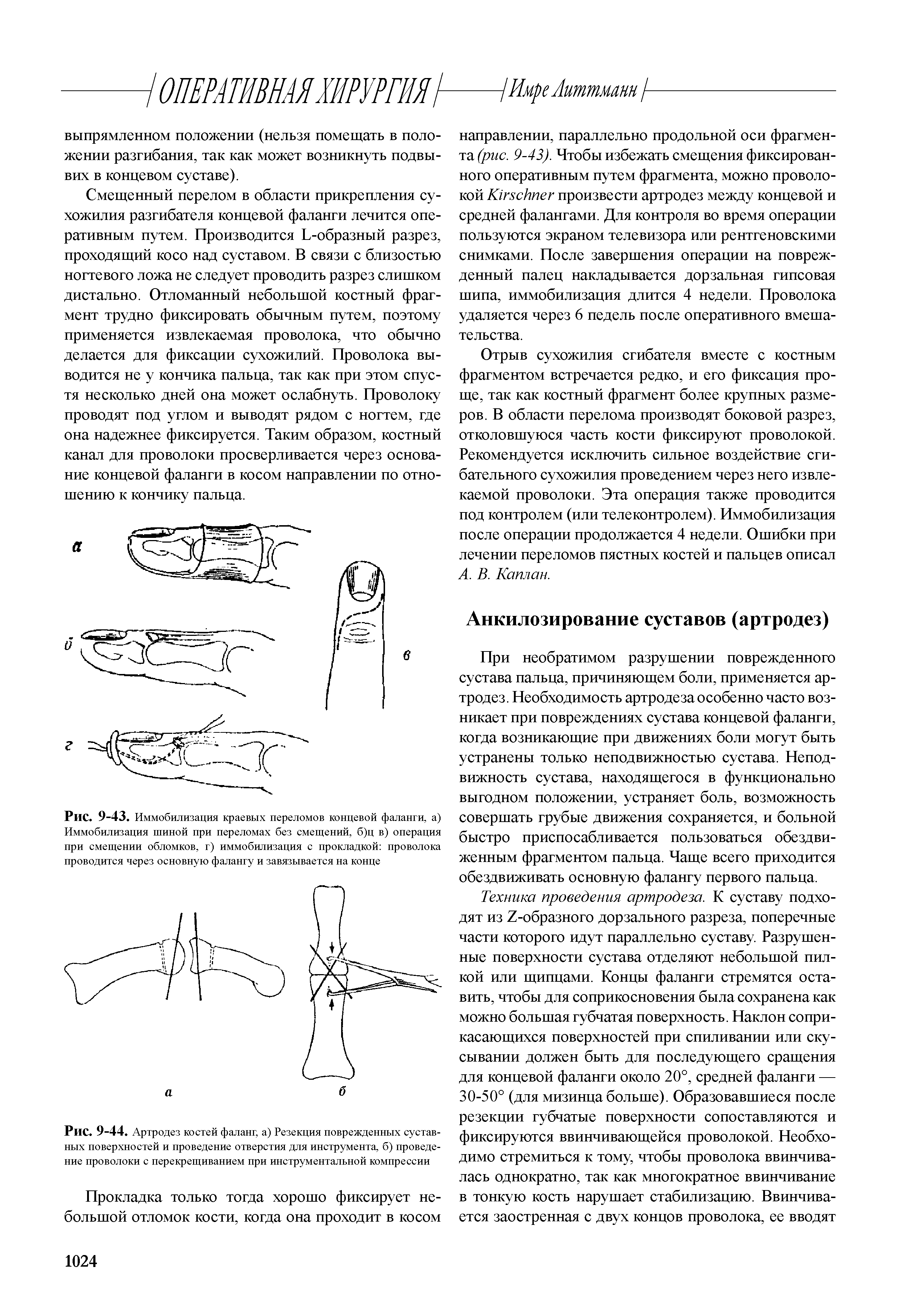 Рис. 9-43. Иммобилизация краевых переломов концевой фаланги, а) Иммобилизация шиной при переломах без смещений, б)ц в) операция при смещении обломков, г) иммобилизация с прокладкой проволока проводится через основную фалангу и завязывается на конце...