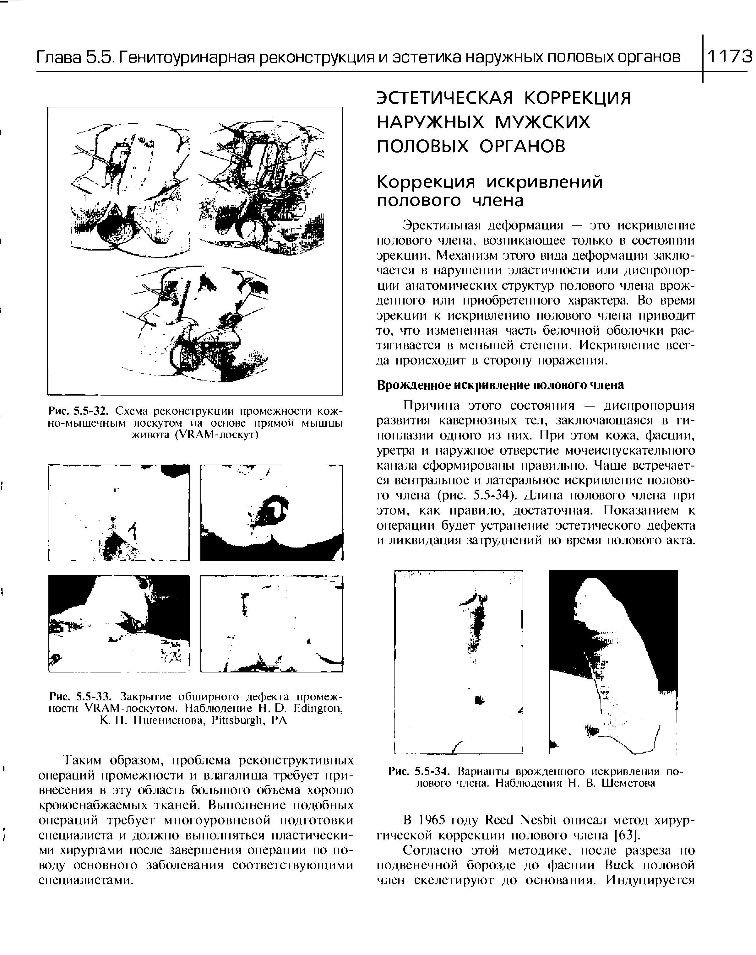 Рис. 5.5-34. Варианты врожденного искривления полового члена. Наблюдения Н. В. Шеметова...