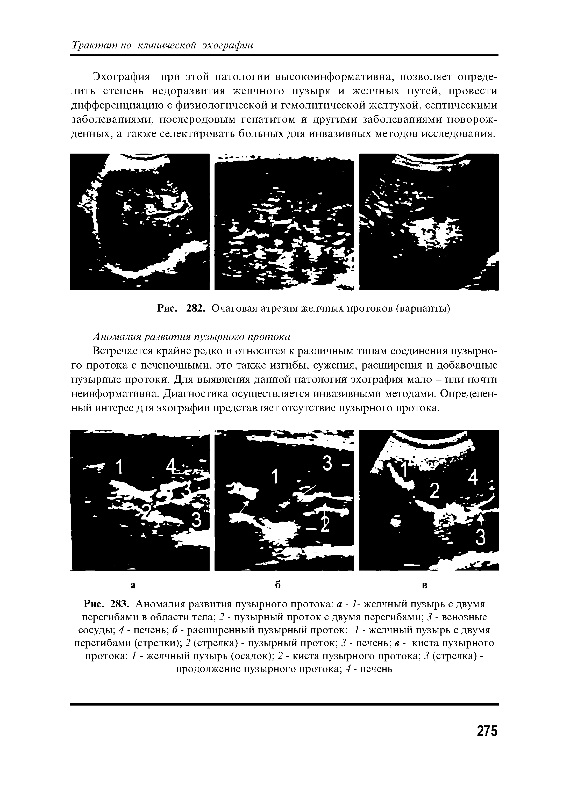 Рис. 283. Аномалия развития пузырного протока а -1- желчный пузырь с двумя перегибами в области тела 2 - пузырный проток с двумя перегибами 3 - венозные сосуды 4 - печень б - расширенный пузырный проток 1 - желчный пузырь с двумя перегибами (стрелки) 2 (стрелка) - пузырный проток 3 - печень в - киста пузырного протока 1 - желчный пузырь (осадок) 2 - киста пузырного протока 3 (стрелка) -продолжение пузырного протока 4 - печень...