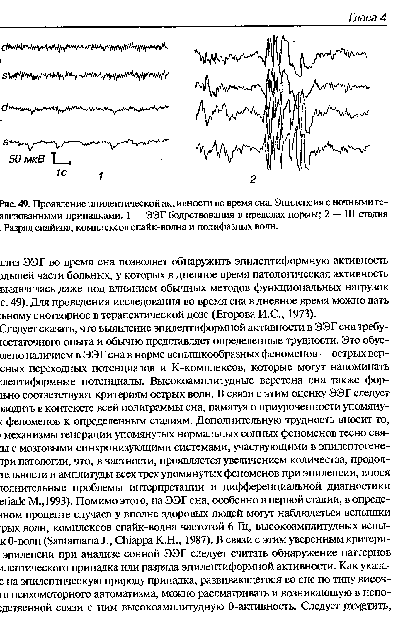 Рис. 49. Проявление эпилептической активности во время сна. Эпилепсия с ночными ге-ализованными припадками. 1 — ЭЭГ бодрствования в пределах нормы 2 — III стадия, Разряд спайков, комплексов спайк-волна и полифазных волн.