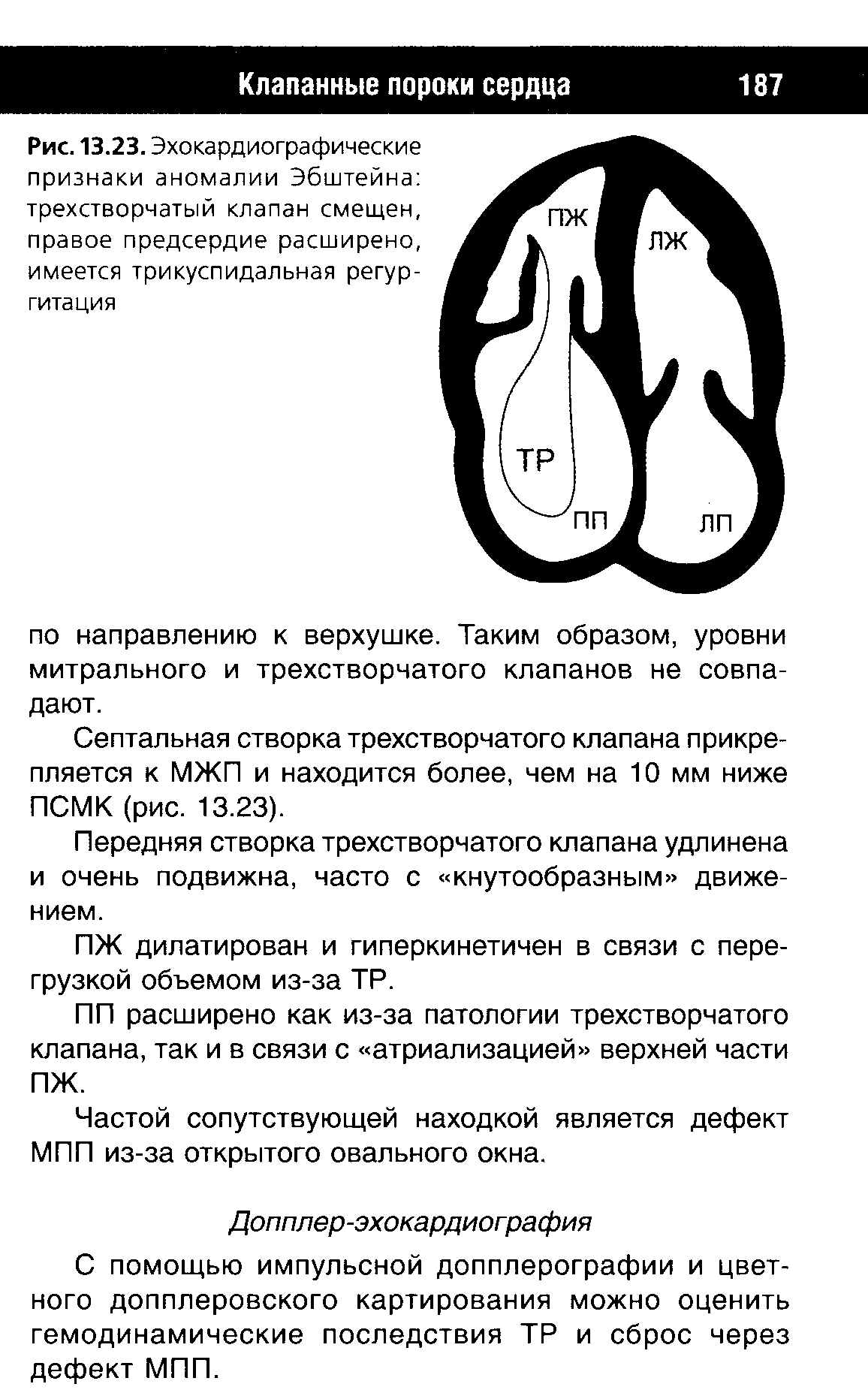 Рис. 13.23. Эхокардиографические признаки аномалии Эбштейна трехстворчатый клапан смещен, правое предсердие расширено, имеется трикуспидальная регургитация...