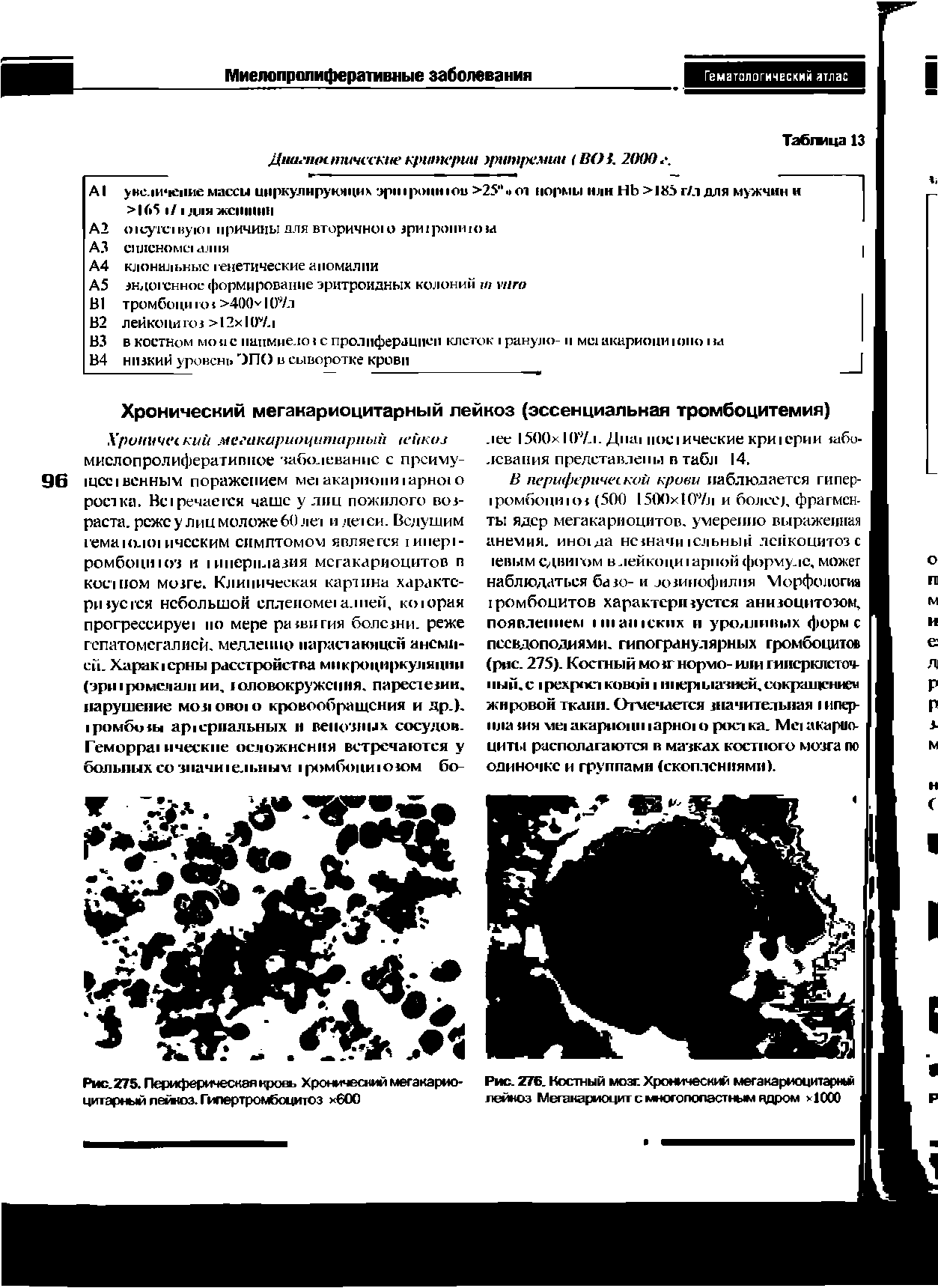 Рис. 276. Костный мозг. Хронический мегакариоцитарный лейкоз Мегакариоцит с многополастным ядром >1000...