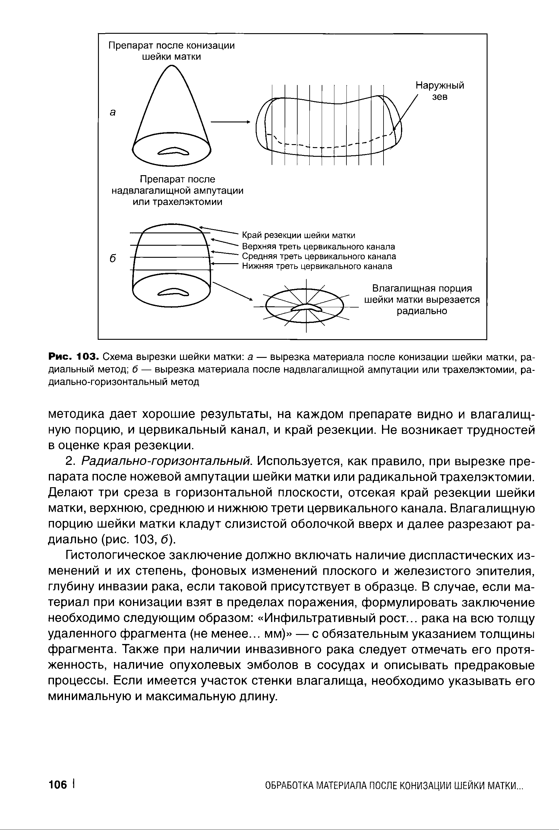 Рис. 103. Схема вырезки шейки матки а — вырезка материала после конизации шейки матки, радиальный метод б — вырезка материала после надвлагалищной ампутации или трахелэктомии, радиально-горизонтальный метод...