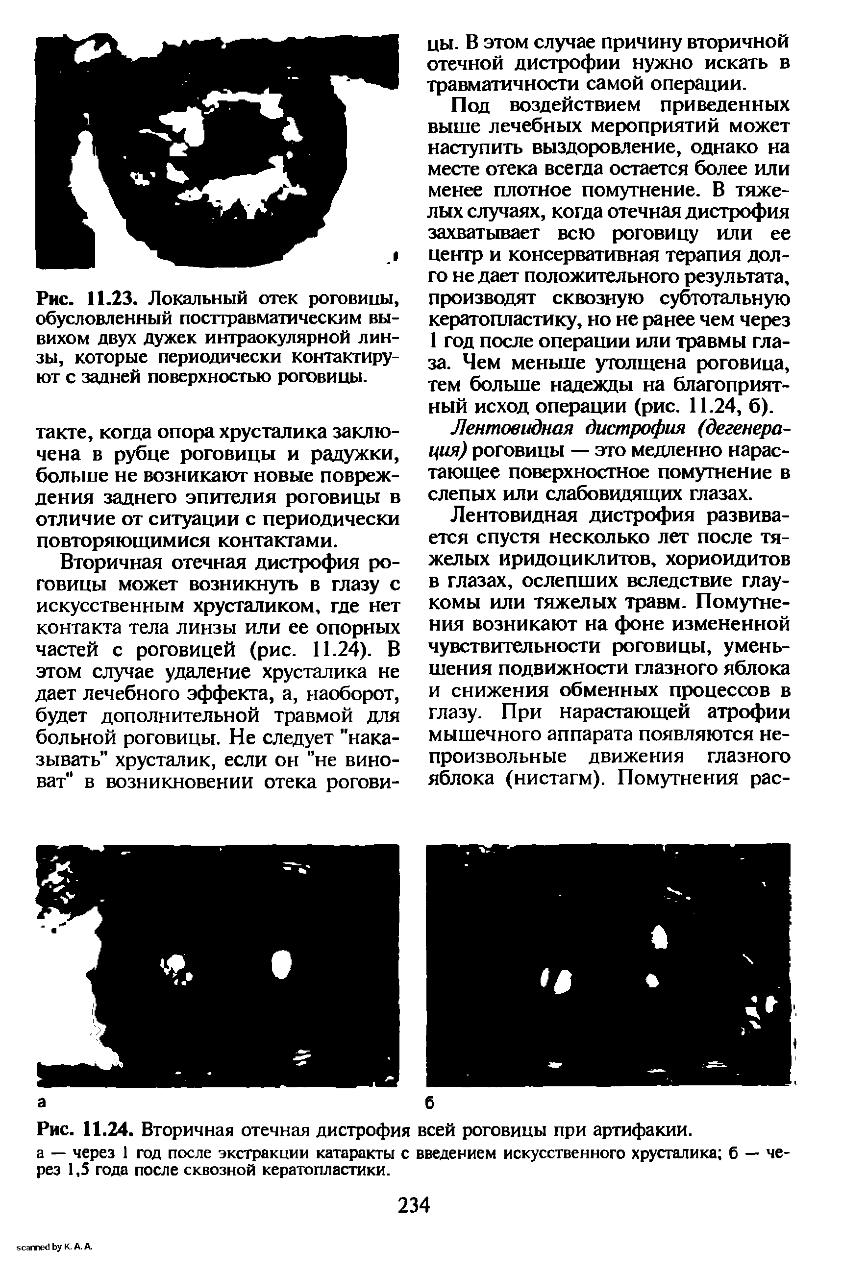 Рис. 11.24. Вторичная отечная дистрофия всей роговицы при артифакии.