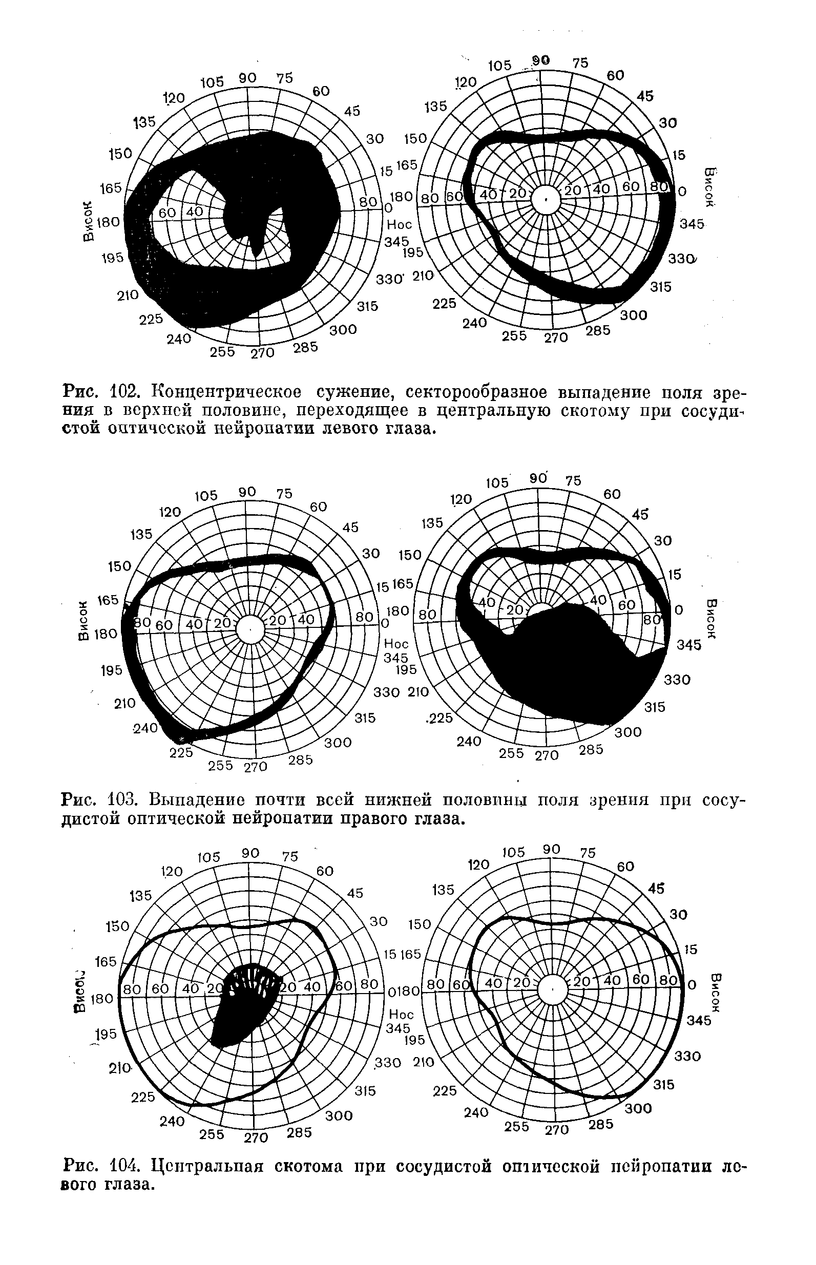 Рис. 102. Концентрическое сужение, секторообразное выпадение поля зрения в верхней половине, переходящее в центральную скотому при сосудистой оптической нейропатии левого глаза.