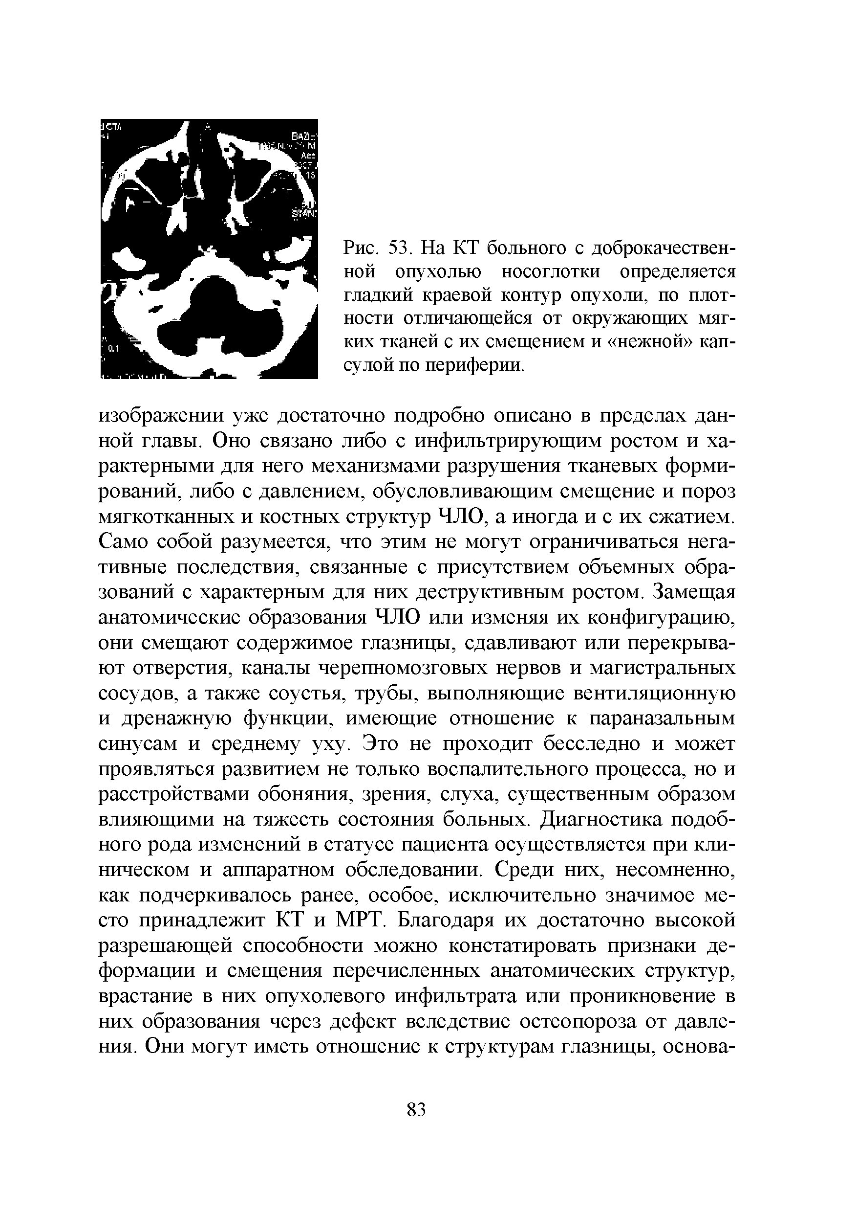 Рис. 53. На КТ больного с доброкачественной опухолью носоглотки определяется гладкий краевой контур опухоли, по плотности отличающейся от окружающих мягких тканей с их смещением и нежной капсулой по периферии.