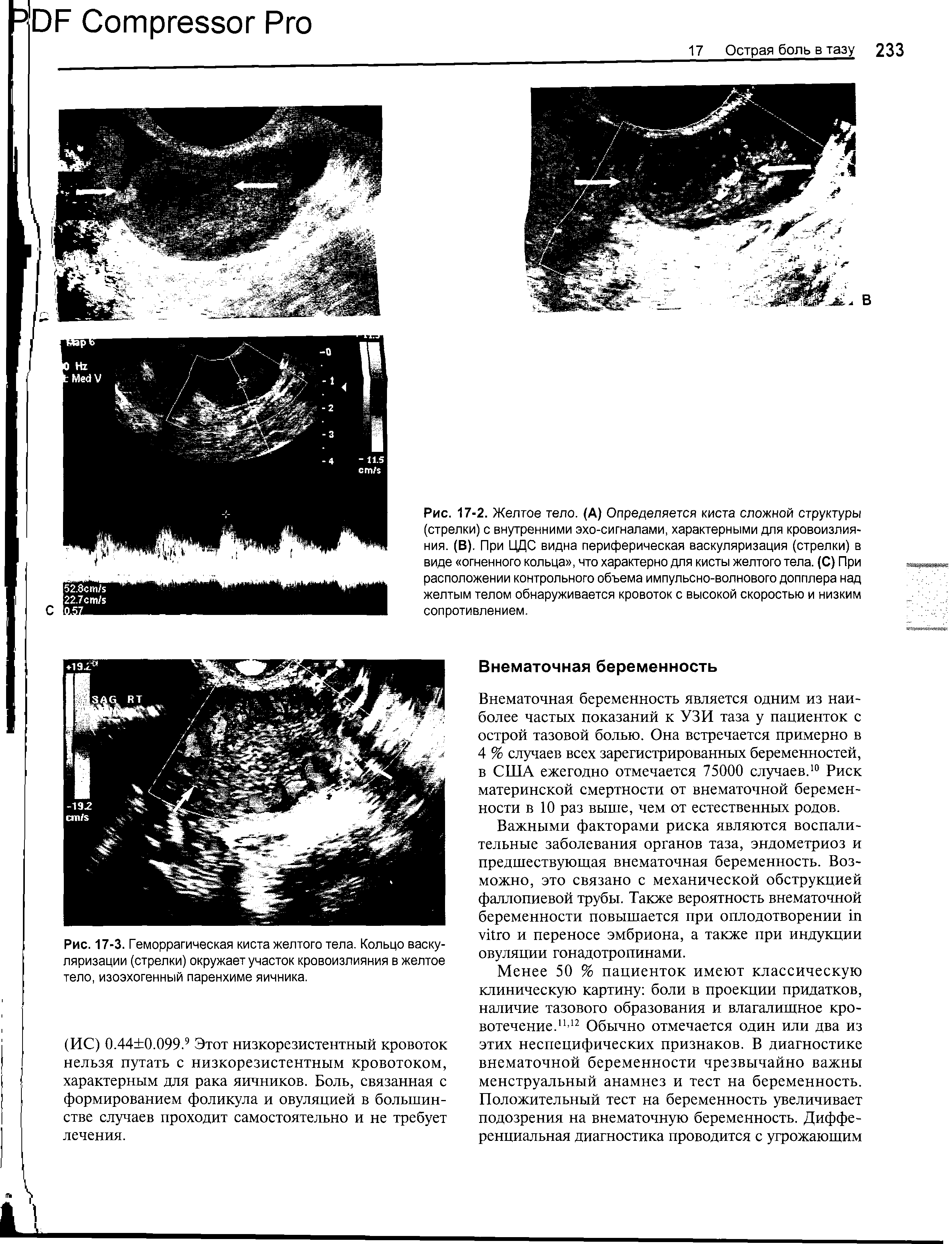 Рис. 17-3. Геморрагическая киста желтого тела. Кольцо васкуляризации (стрелки) окружает участок кровоизлияния в желтое тело, изоэхогенный паренхиме яичника.