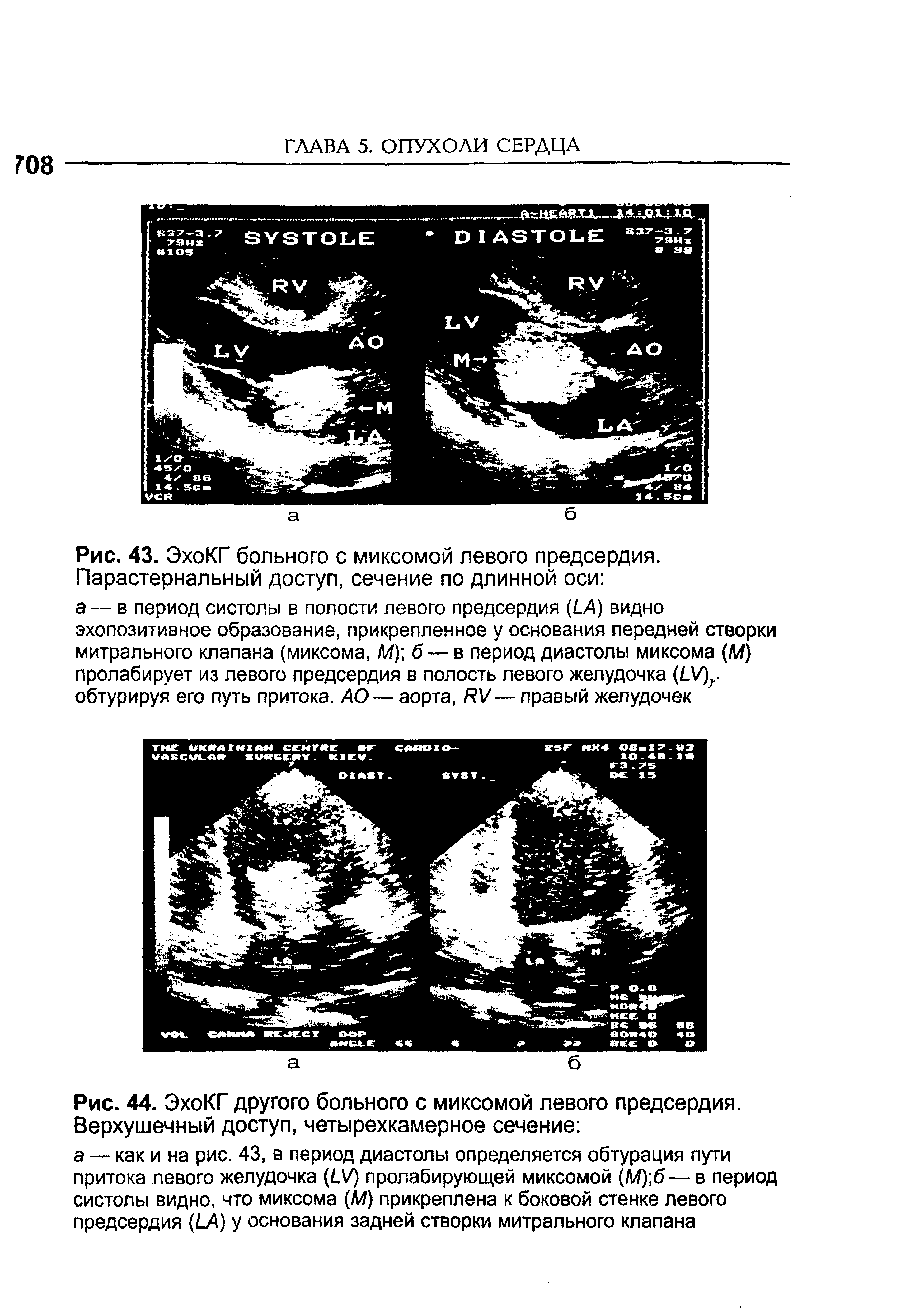 Рис. 43. ЭхоКГ больного с миксомой левого предсердия. Парастернальный доступ, сечение по длинной оси ...