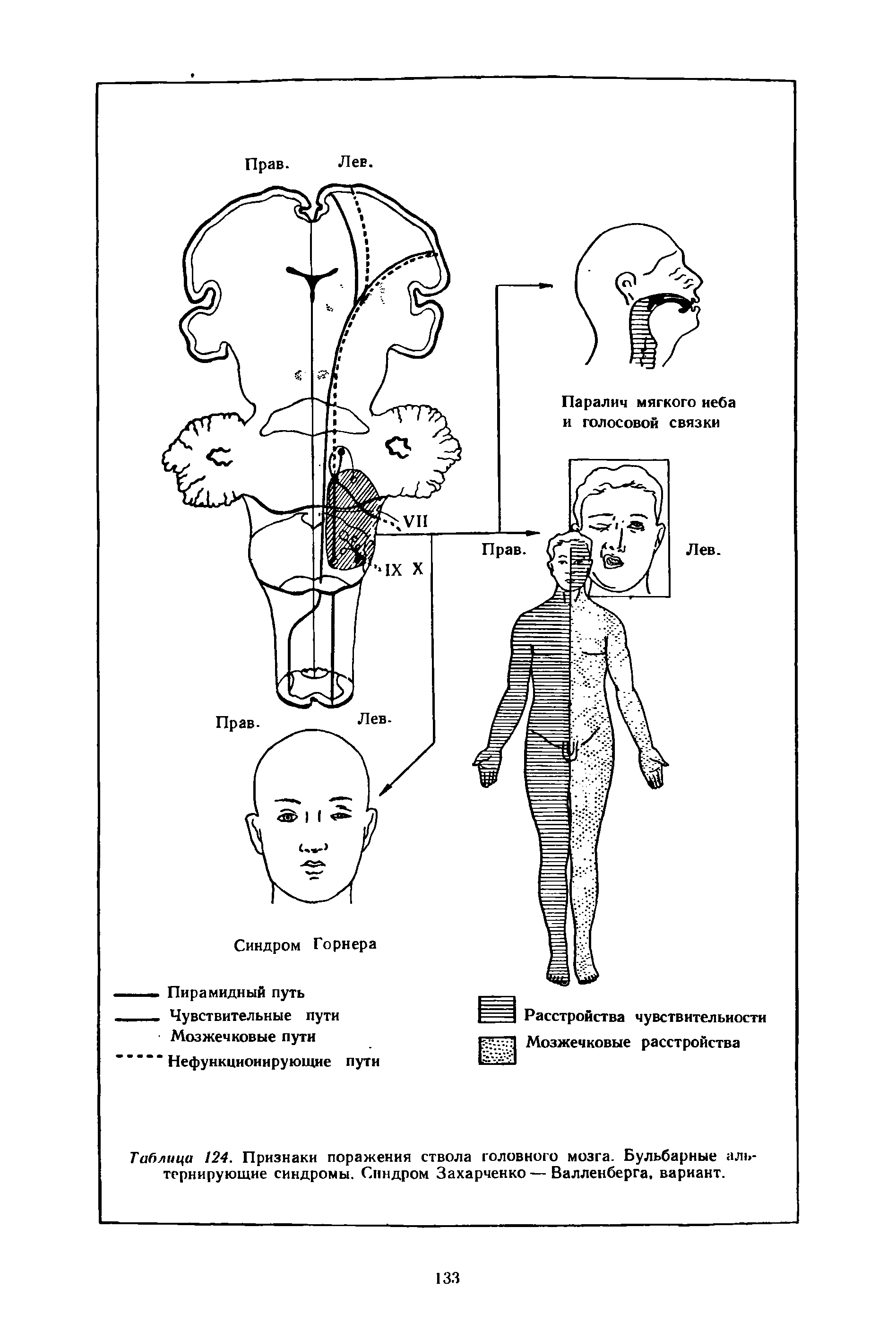 Таблица 124. Признаки поражения ствола головного мозга. Бульбарные альтернирующие синдромы. Синдром Захарченко — Валленберга, вариант.