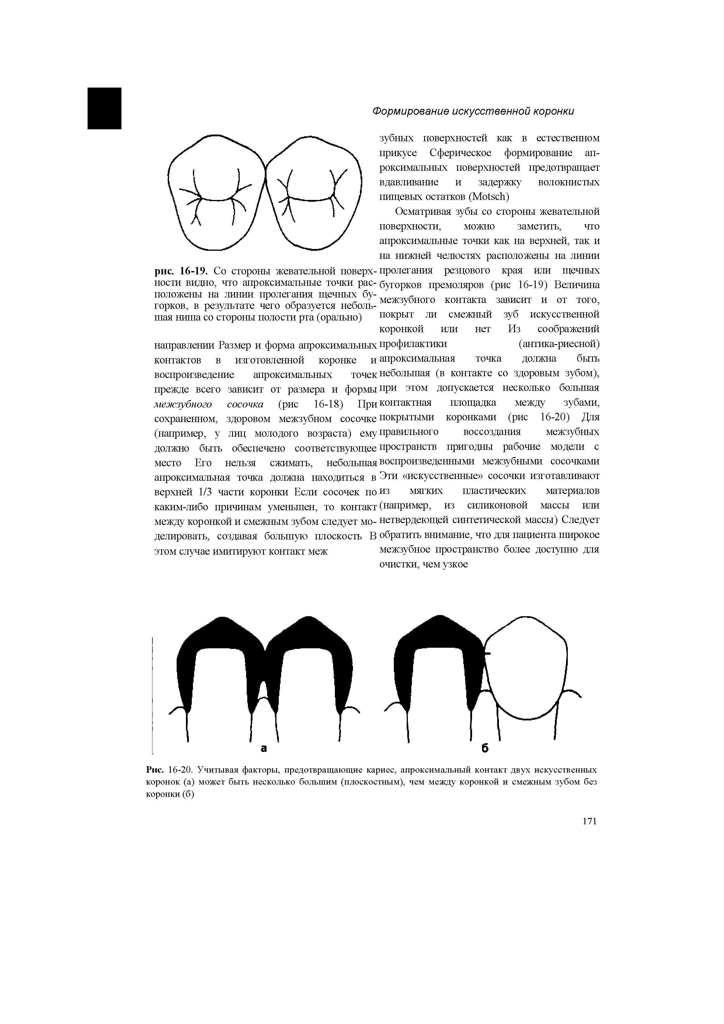 Рис. 16-20. Учитывая факторы, предотвращающие кариес, апроксимальный контакт двух искусственных коронок (а) может быть несколько большим (плоскостным), чем между коронкой и смежным зубом без коронки (б)...