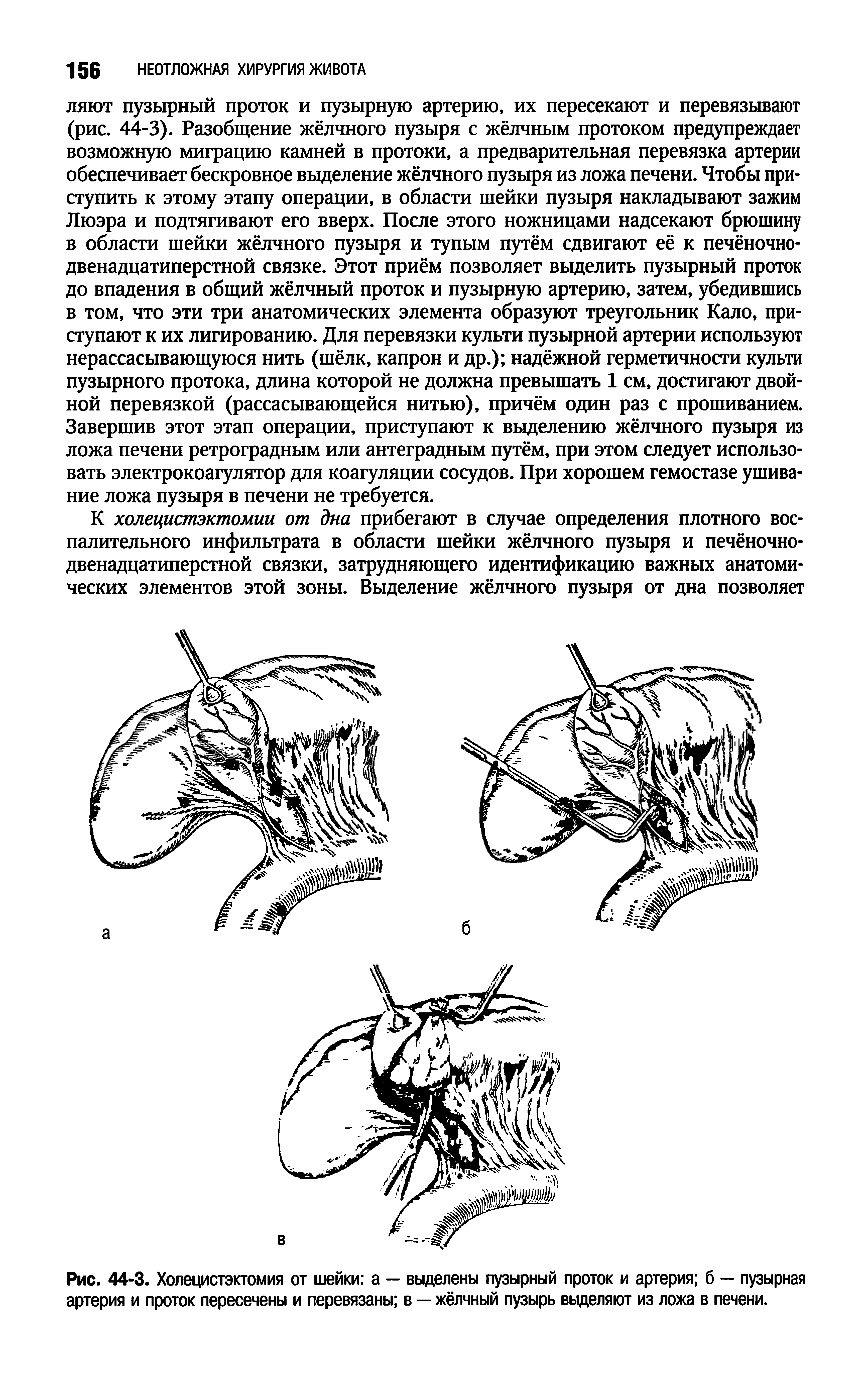 Рис. 44-3. Холецистэктомия от шейки а — выделены пузырный проток и артерия б — пузырная артерия и проток пересечены и перевязаны в — жёлчный пузырь выделяют из ложа в печени.