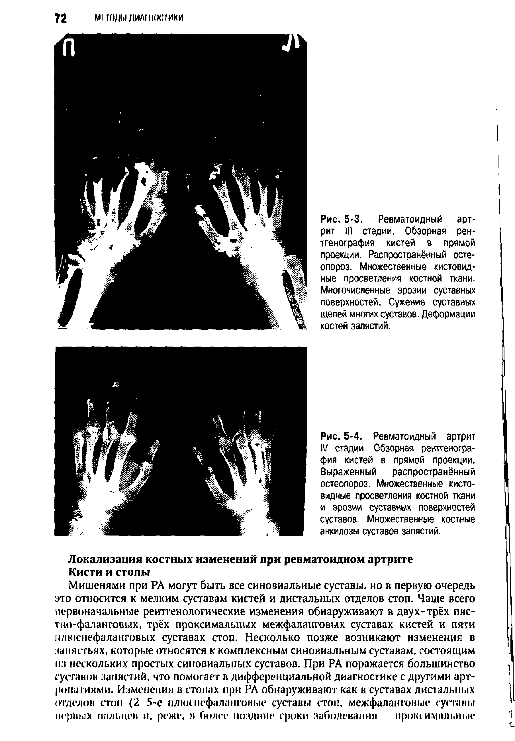 Рис. 5-3. Ревматоидный артрит 111 стадии. Обзорная рентгенография кистей в прямой проекции. Распространённый остеопороз. Множественные кистовидные просветления костной ткани. Многочисленные эрозии суставных поверхностей. Сужение суставных щелей многих суставов. Деформации костей запястий.