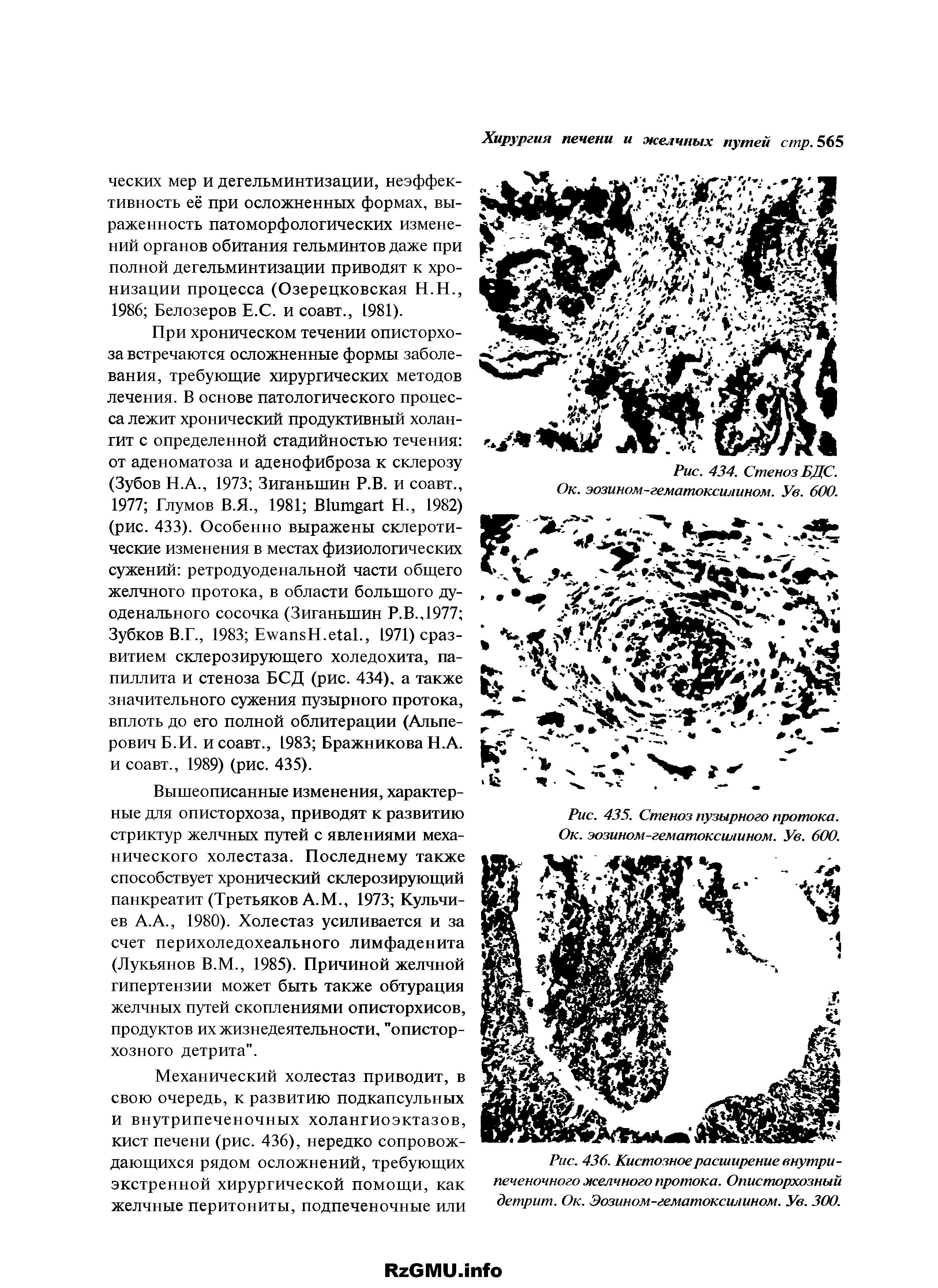 Рис. 436. Кистозное расширение внутри -печеночного желчного протока. Описторхозный детрит. Ок. Эозином-гематоксилином. Ув. 300.