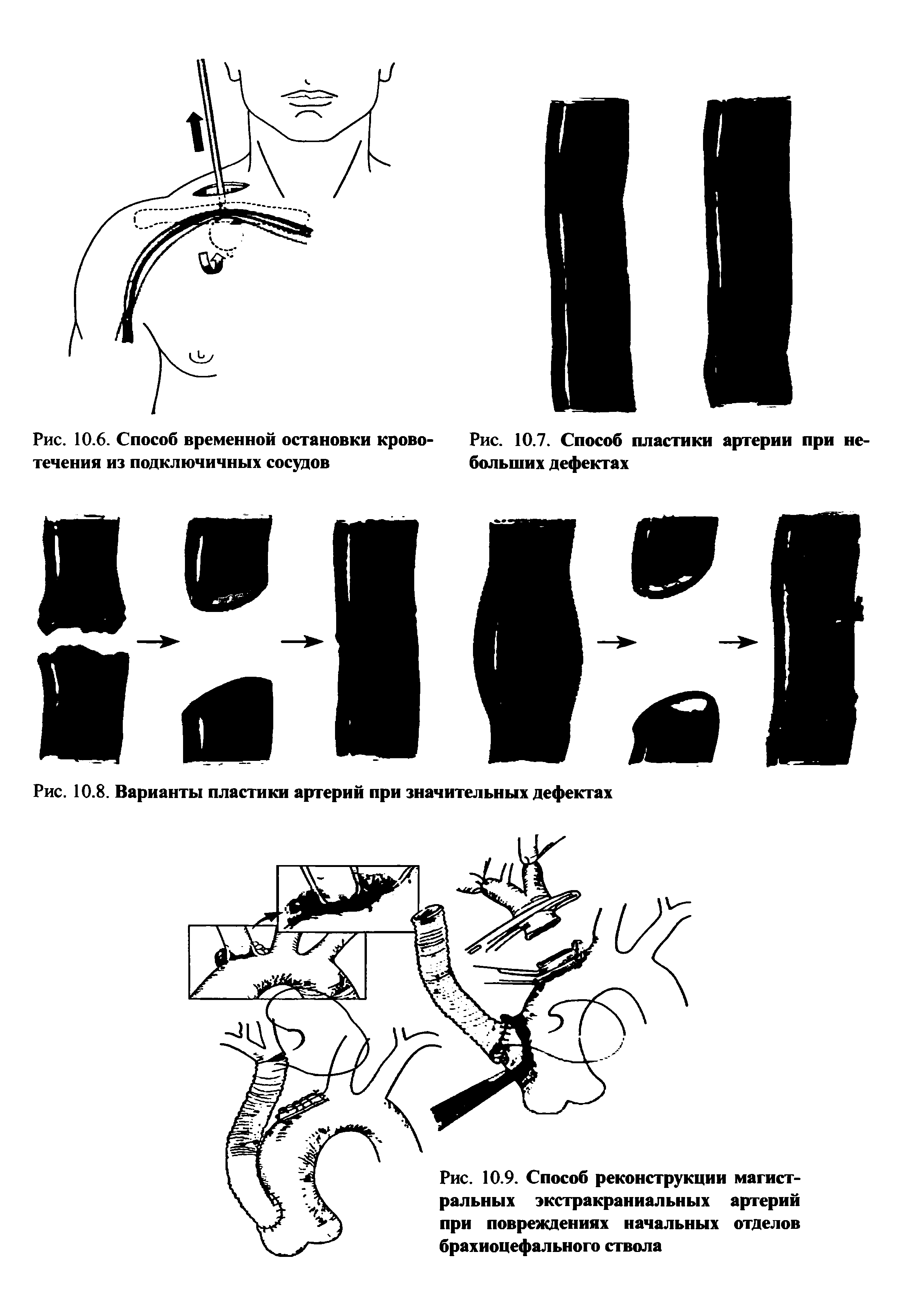 Рис. 10.9. Способ реконструкции магистральных экстракраниальных артерий при повреждениях начальных отделов брахиоцефального ствола...