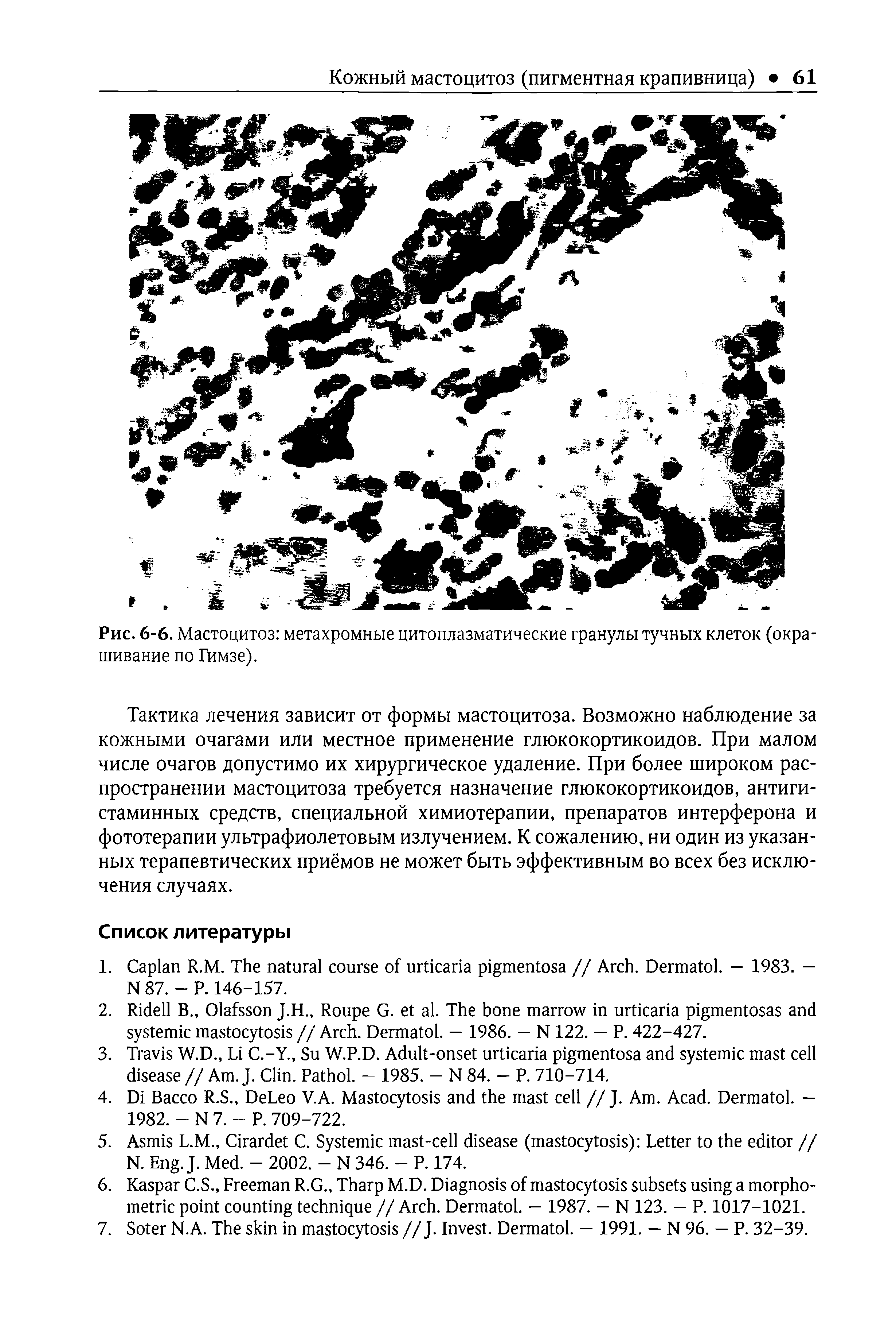 Рис. 6-6. Мастоцитоз метахромные цитоплазматические гранулы тучных клеток (окрашивание по Гимзе).