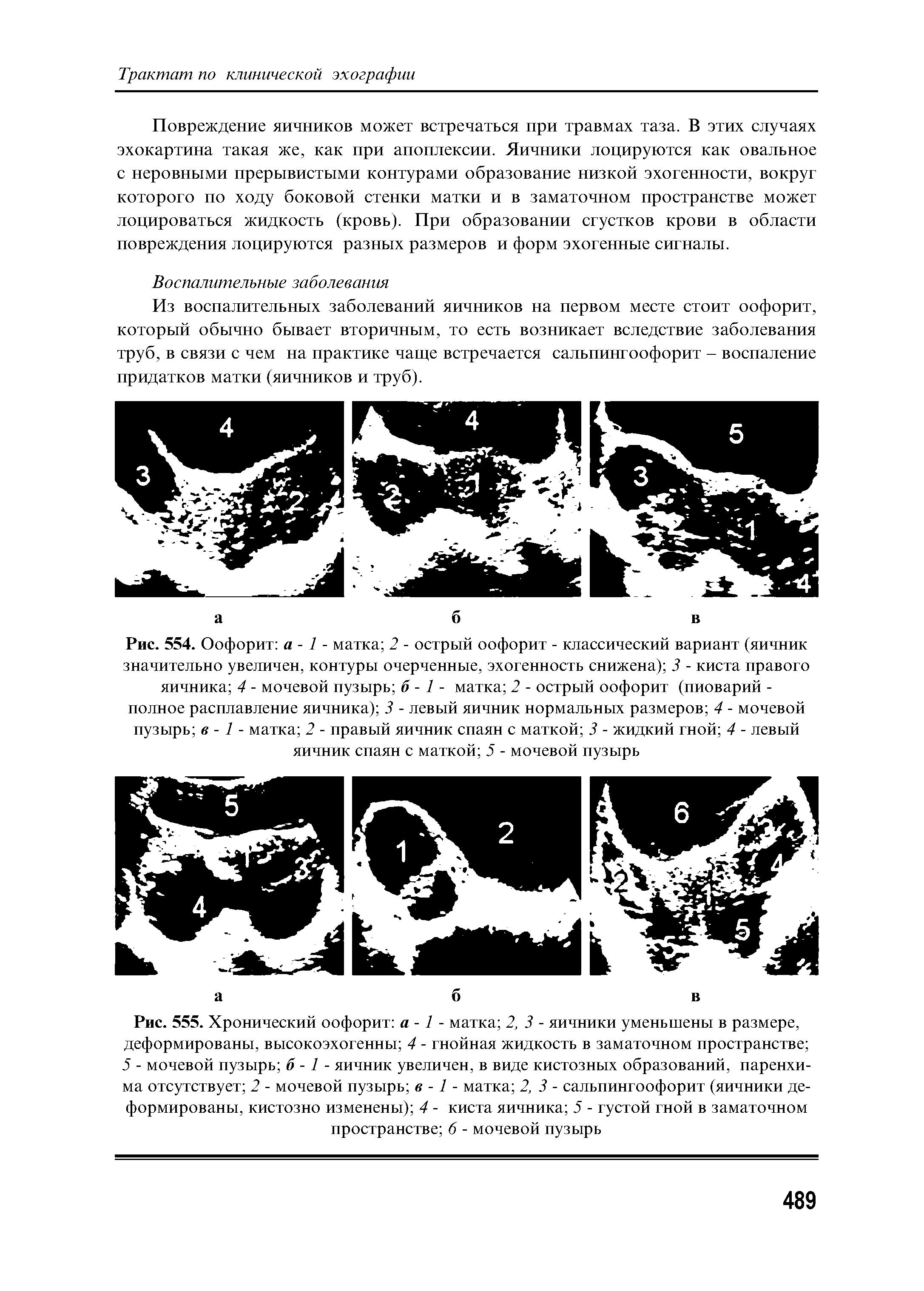 Рис. 554. Оофорит а - 1 - матка 2 - острый оофорит - классический вариант (яичник значительно увеличен, контуры очерченные, эхогенность снижена) 3 - киста правого яичника 4 - мочевой пузырь б - 1 - матка 2 - острый оофорит (пиоварий -полное расплавление яичника) 3 - левый яичник нормальных размеров 4 - мочевой пузырь в - 1 - матка 2 - правый яичник спаян с маткой 3 - жидкий гной 4 - левый яичник спаян с маткой 5 - мочевой пузырь...