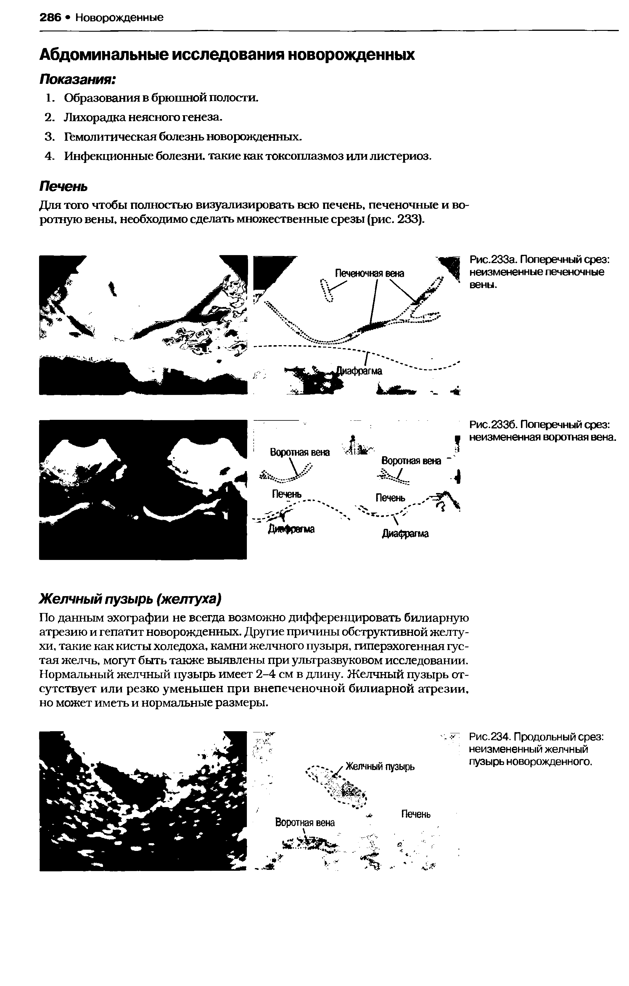 Рис.234. Продольный срез неизмененный желчный пузырь новорожденного.