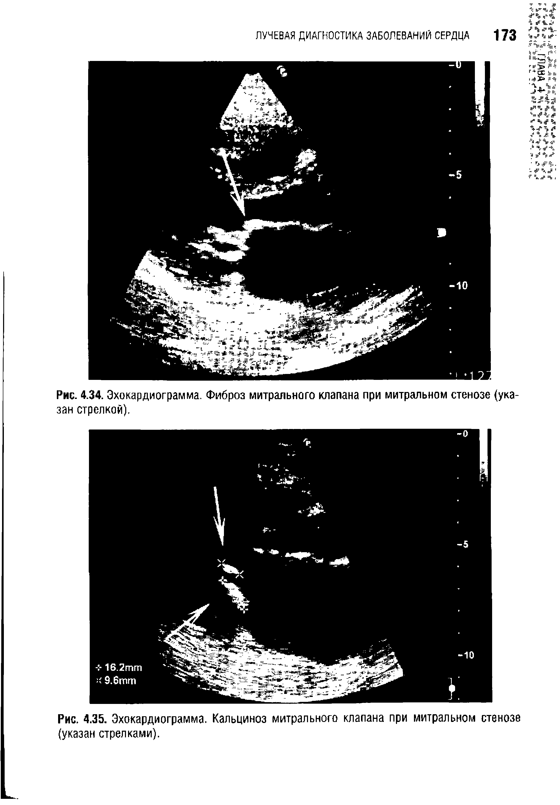 Рис. 4.35. Эхокардиограмма. Кальциноз митрального клапана при митральном стенозе (указан стрелками).
