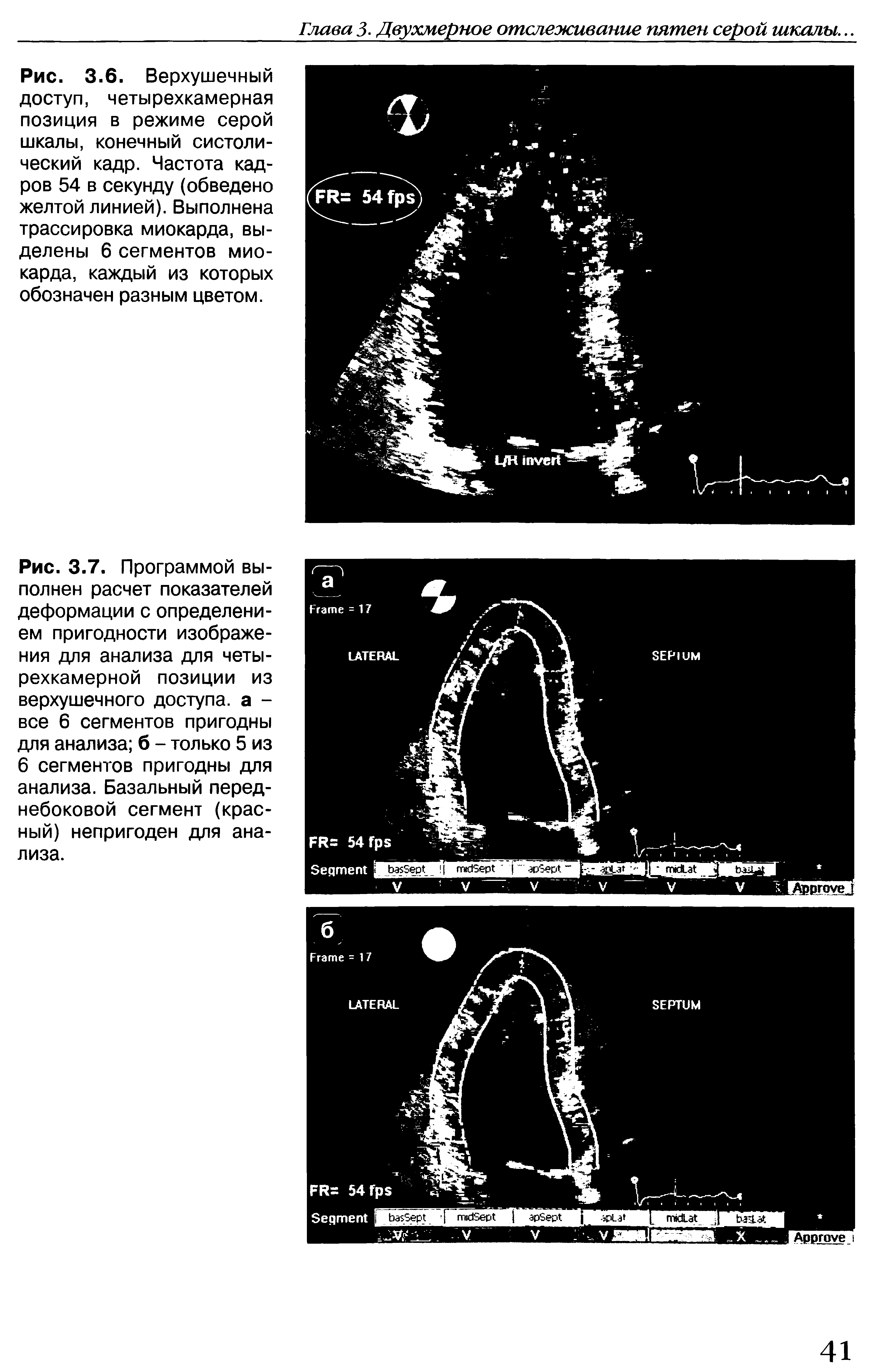 Рис. 3.6. Верхушечный доступ, четырехкамерная позиция в режиме серой шкалы, конечный систолический кадр. Частота кадров 54 в секунду (обведено желтой линией). Выполнена трассировка миокарда, выделены 6 сегментов миокарда, каждый из которых обозначен разным цветом.