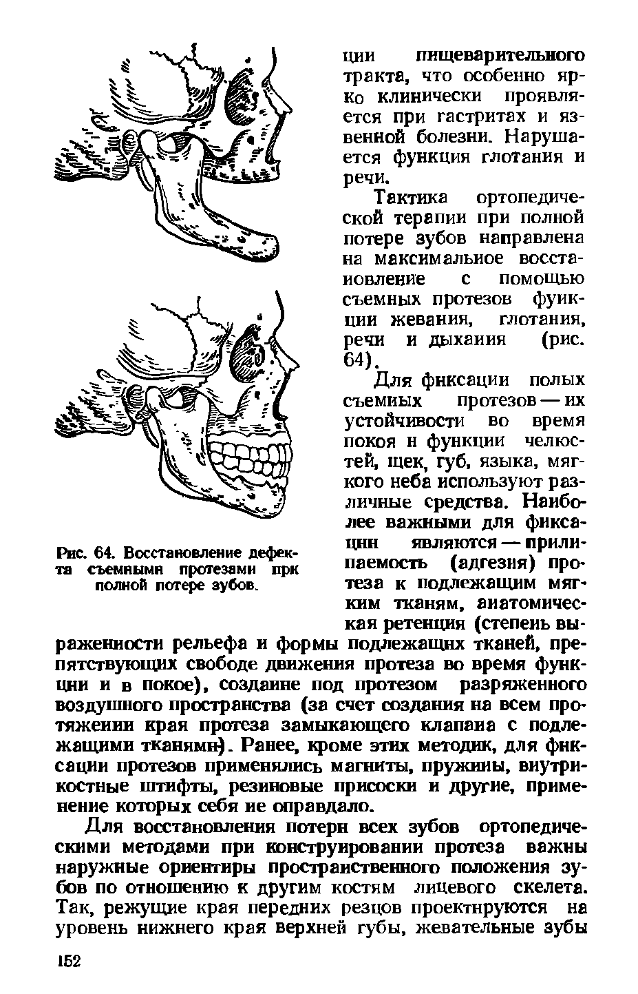 Рис. 64. Восстановление дефекта съемными протезами прк полной потере зубов.