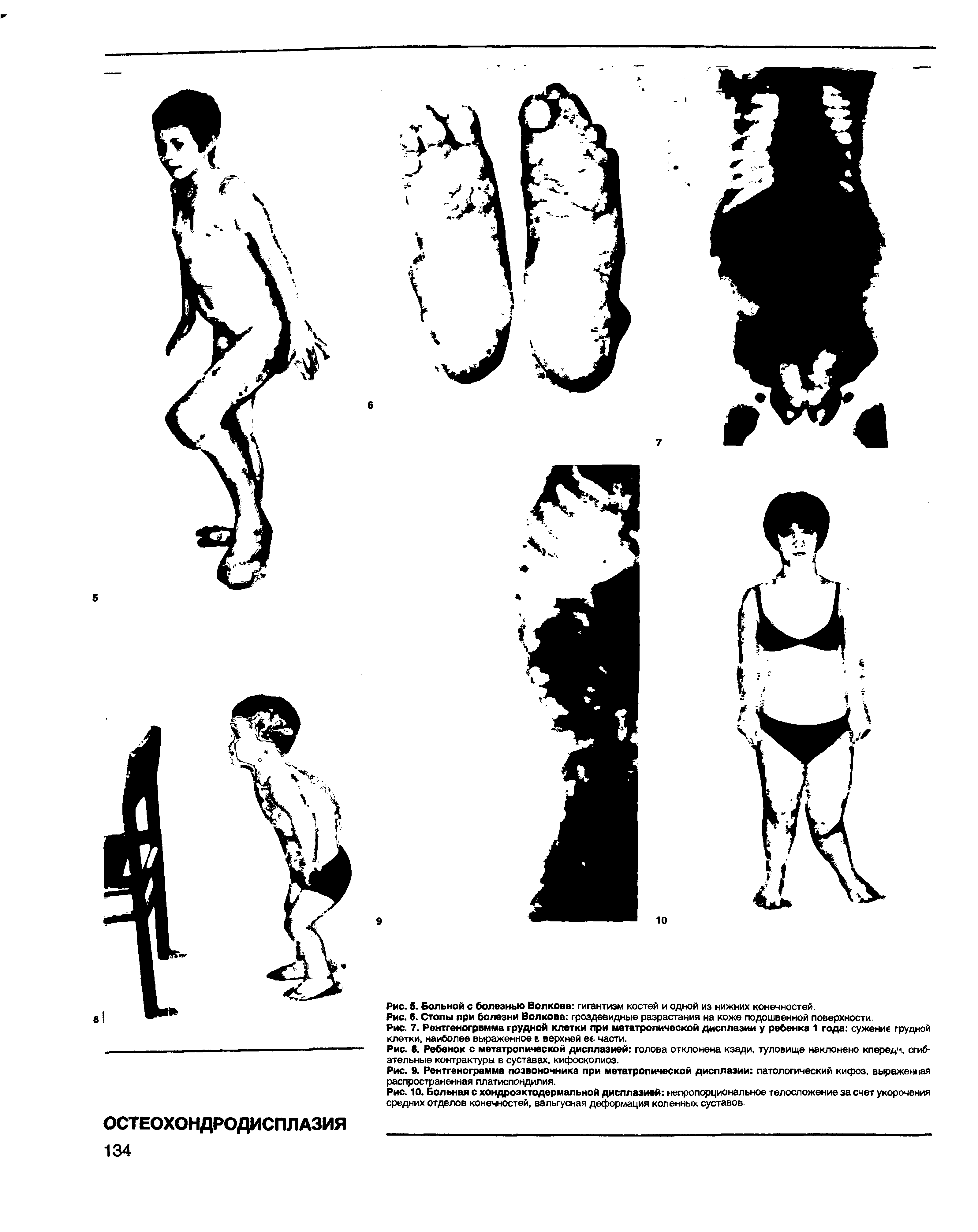 Рис. 8. Ребенок с метатропической дисплазией голова отклонена кзади, туловище наклонено кпередм, сгибательные контрактуры в суставах, кифосколиоз.