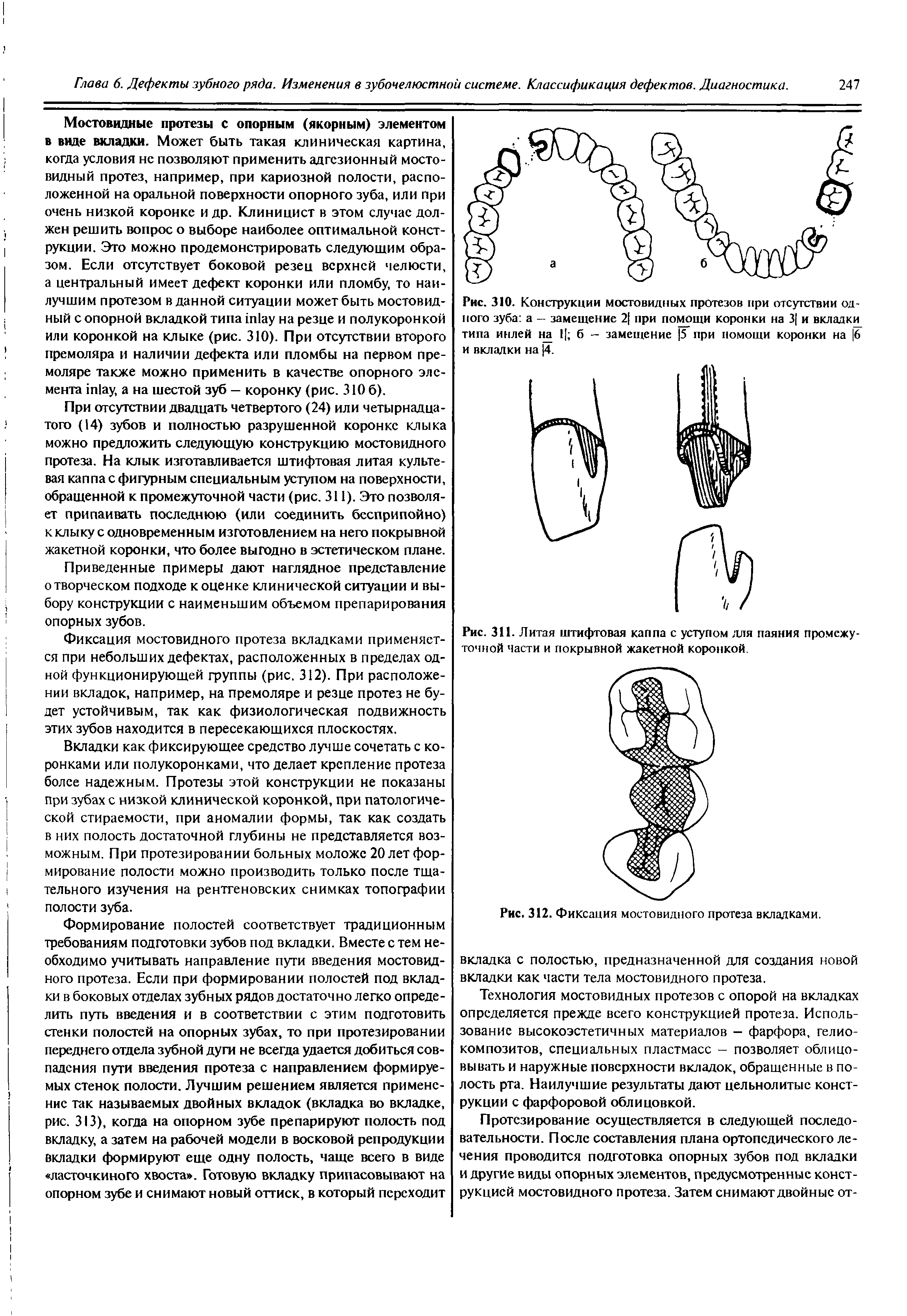 Рис. 310. Конструкции мостовидных протезов при отсутствии одного зуба а — замещение 2 при помощи коронки на 3 и вкладки типа инлей на 1 б - замещение 5 при помощи коронки на 6 и вкладки на 4.