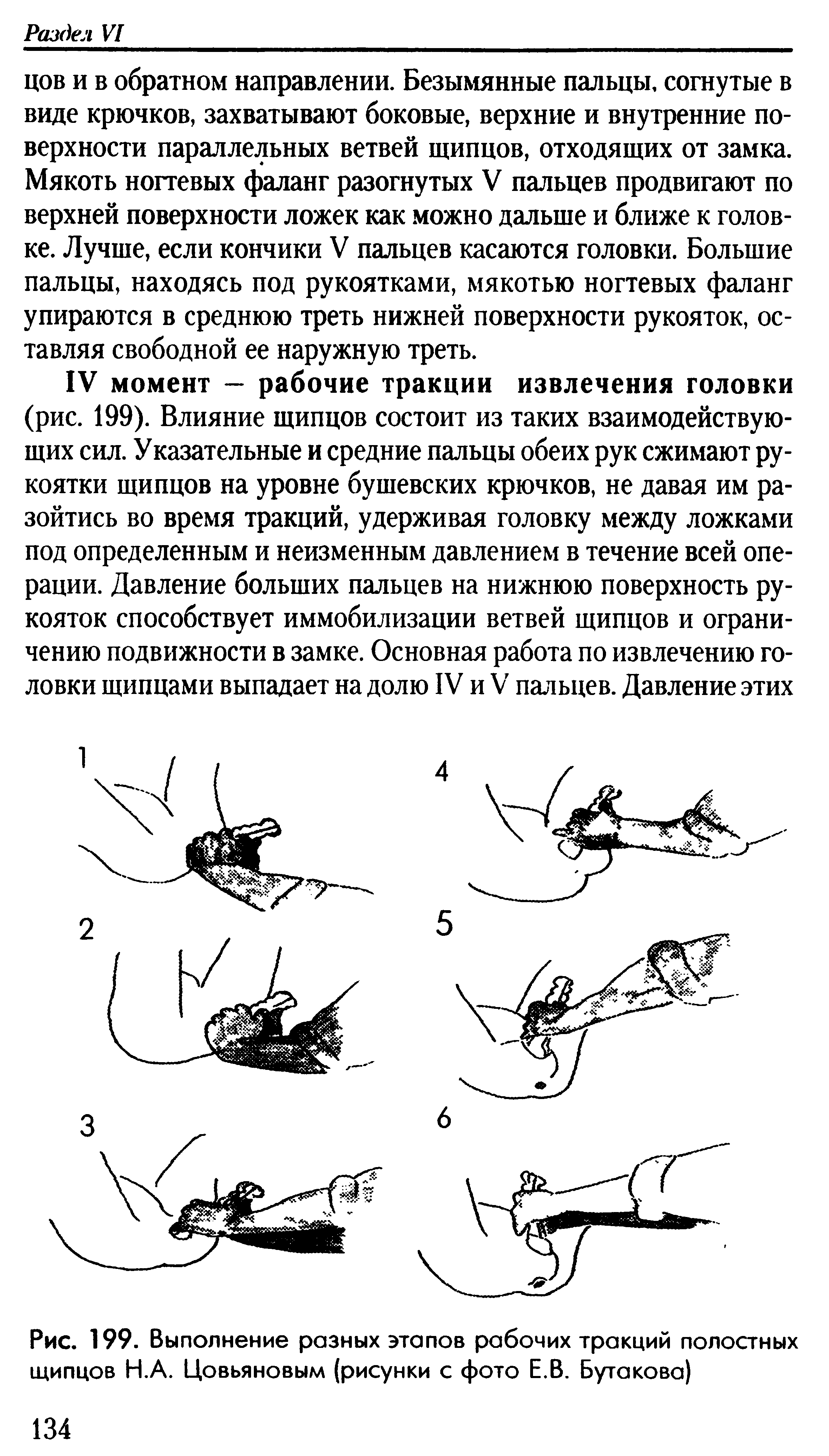 Рис. 199. Выполнение разных этапов рабочих тракций полостных щипцов Н.А. Цовьяновым (рисунки с фото Е.В. Бутакова)...