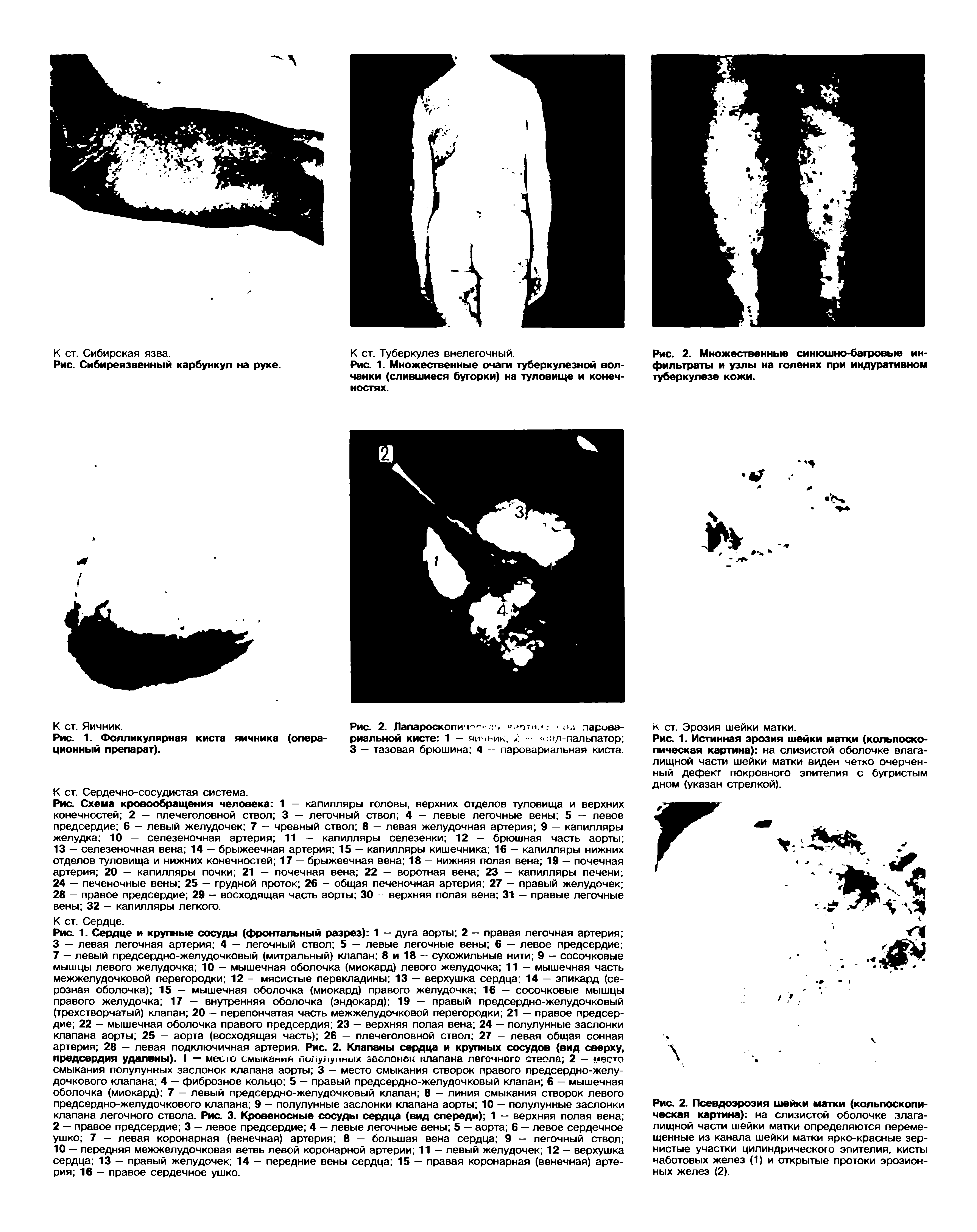 Рис. 1. Истинная эрозия шейки матки (кольпоско-пическая картина) на слизистой оболочке влагалищной части шейки матки виден четко очерченный дефект покровного эпителия с бугристым дном (указан стрелкой).