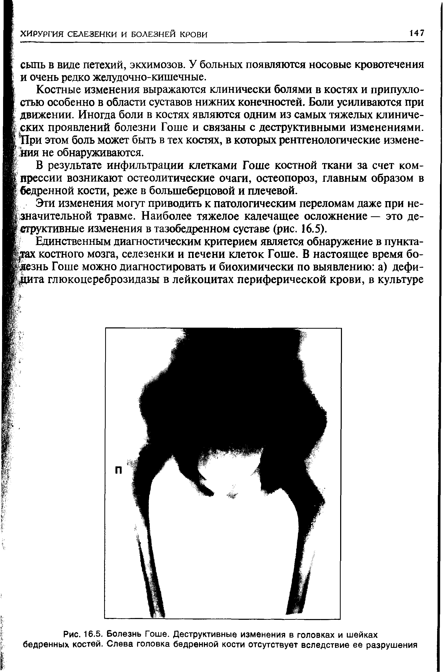 Рис. 16.5. Болезнь Гоше. Деструктивные изменения в головках и шейках бедренных костей. Слева головка бедренной кости отсутствует вследствие ее разрушения...