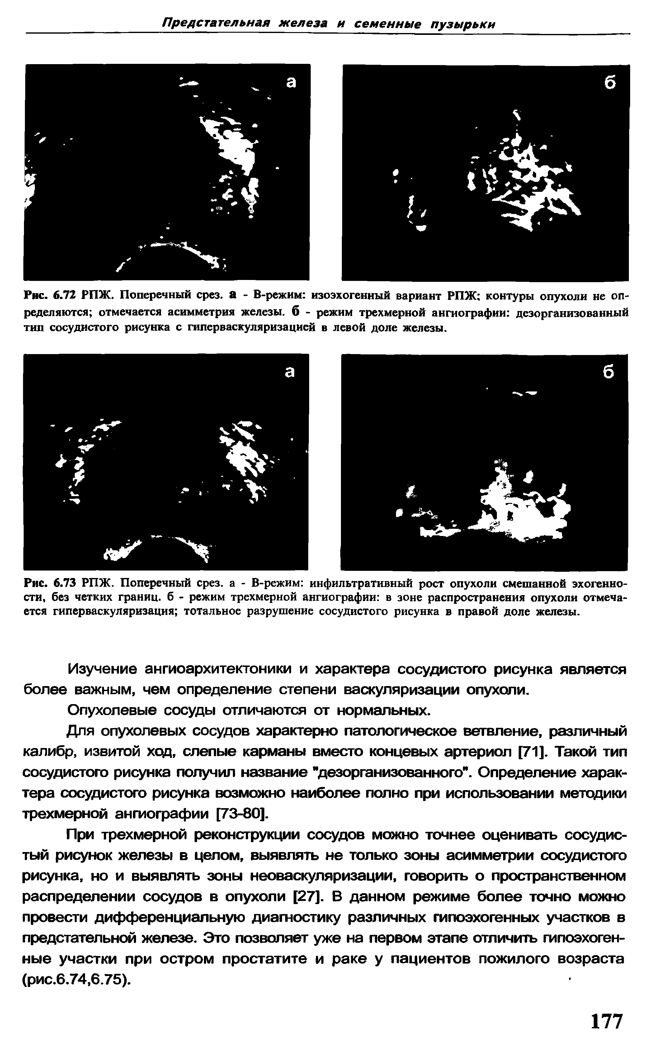 Рис. 6.73 РПЖ. Поперечный срез, а - В-режим инфильтративный рост опухоли смешанной эхогенности, без четких границ, б - режим трехмерной ангиографии в зоне распространения опухоли отмечается гиперваскуляризация тотальное разрушение сосудистого рисунка в правой доле железы.