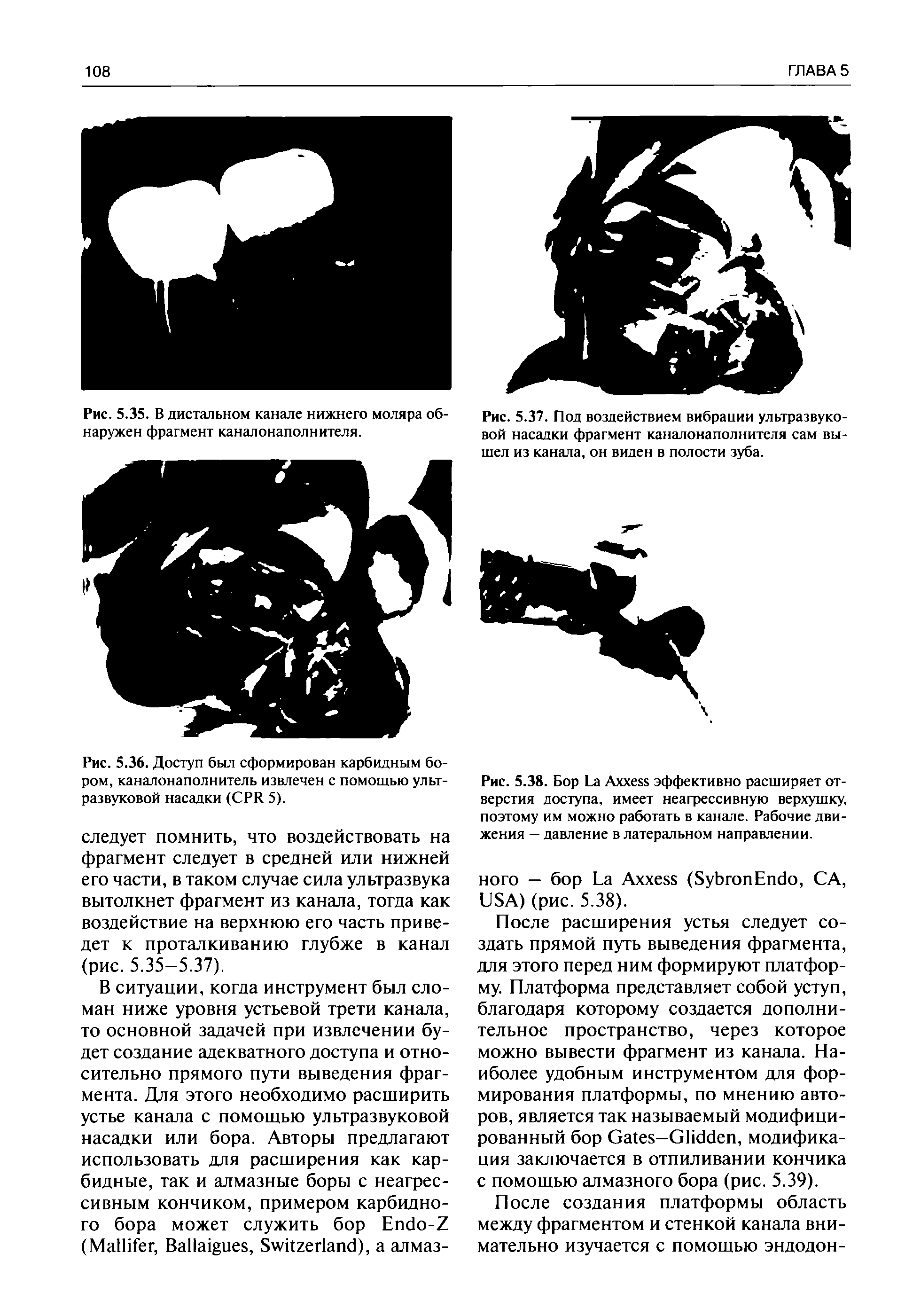 Рис. 5.38. Бор L A эффективно расширяет отверстия доступа, имеет неагрессивную верхушку, поэтому им можно работать в канале. Рабочие движения — давление в латеральном направлении.