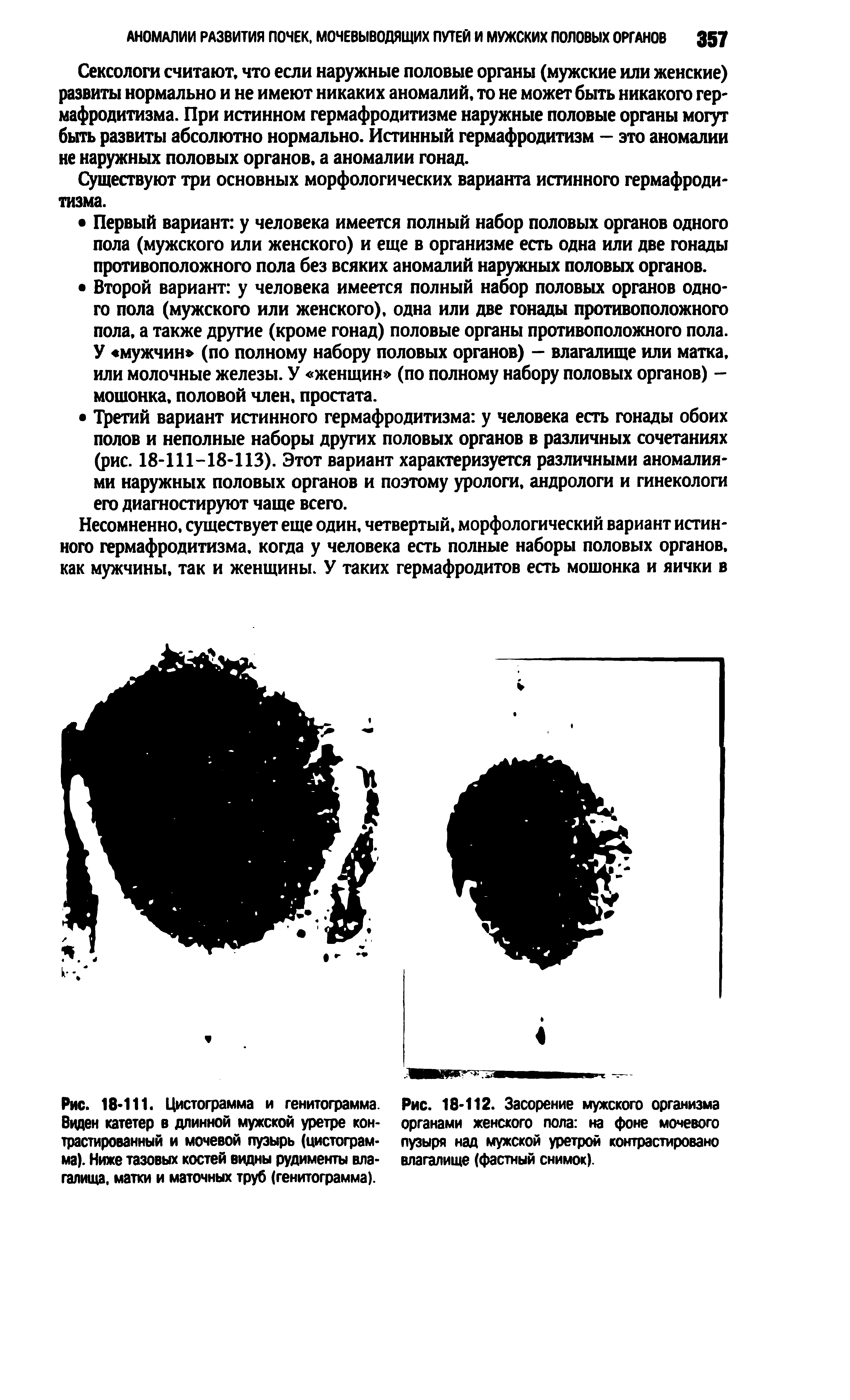 Рис. 18-112. Засорение мужского организма органами женского пола на фоне мочевого пузыря над мужской уретрой контрастировано влагалище (фастный снимок).